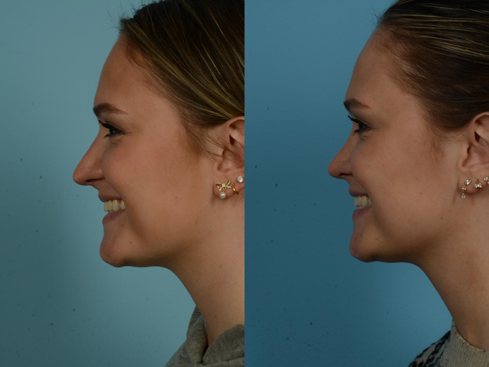 Before & After Rhinoplasty by Dr. Sinno Case 1045 Left Side View in Chicago, IL