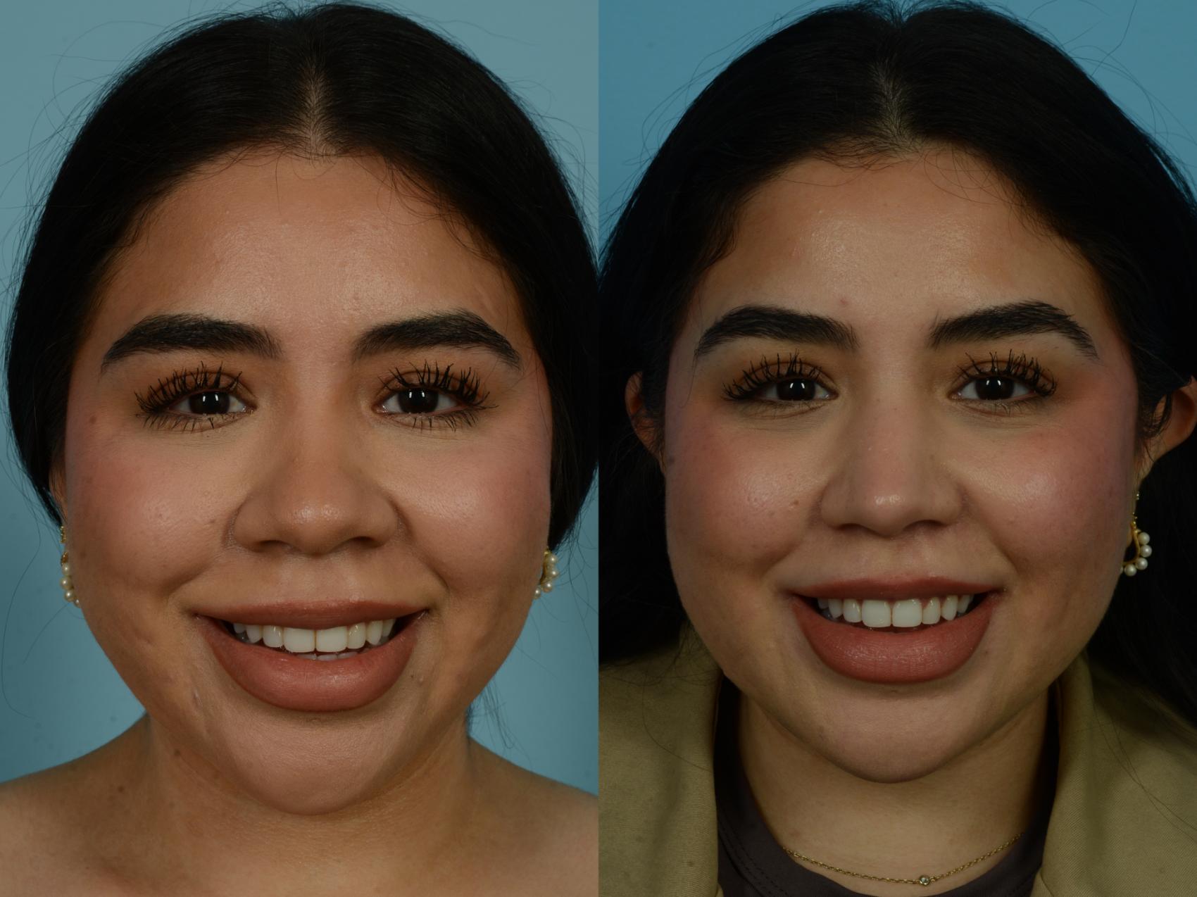 Before & After Rhinoplasty by Dr. Sinno Case 1067 Front View in Chicago, IL