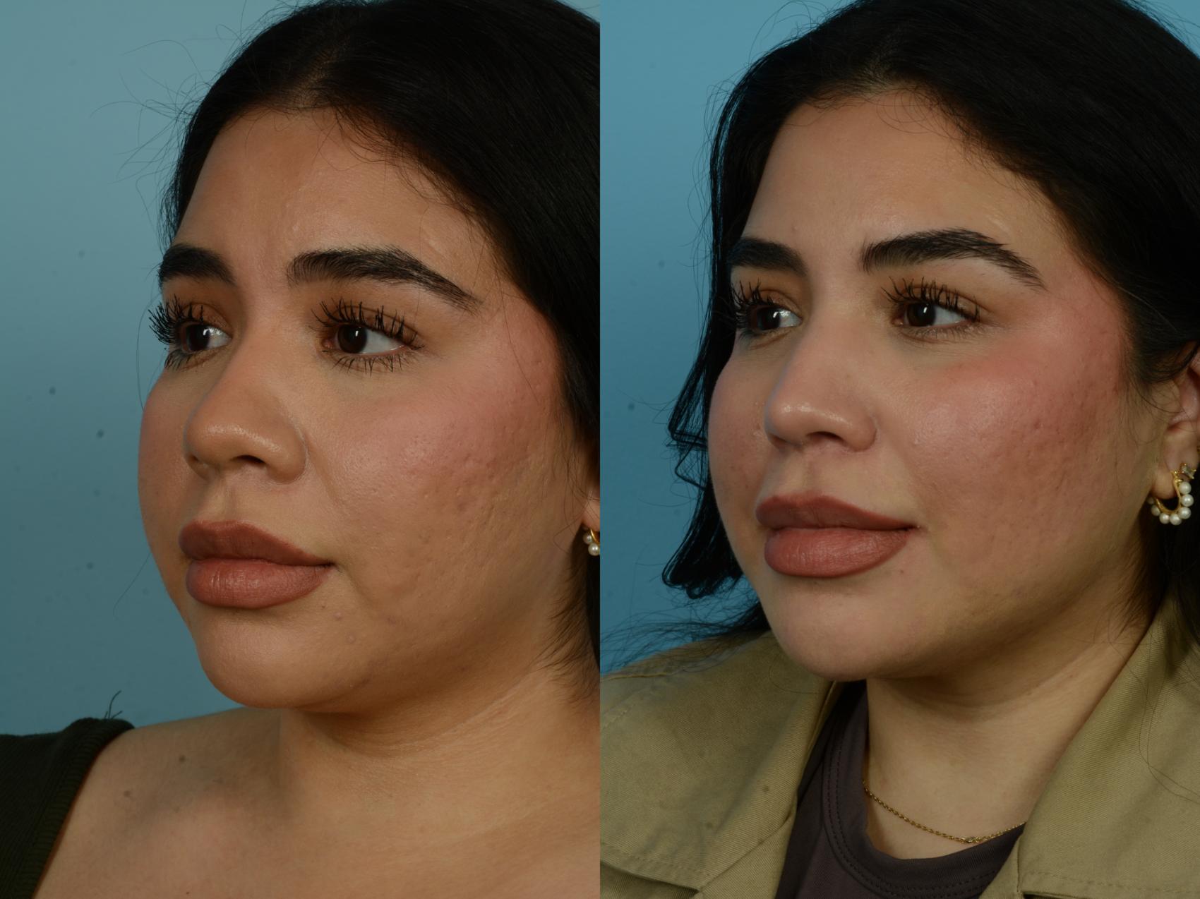 Before & After Rhinoplasty by Dr. Sinno Case 1067 Left Oblique View in Chicago, IL