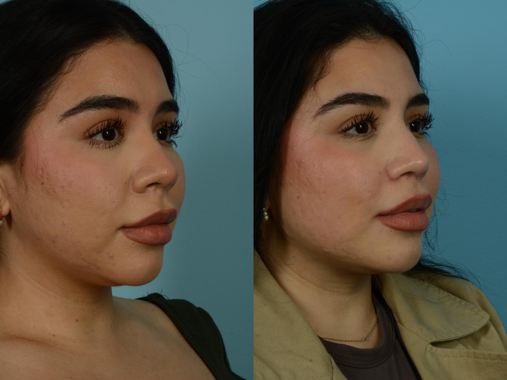 Before & After Rhinoplasty by Dr. Sinno Case 1067 Right Oblique View in Chicago, IL