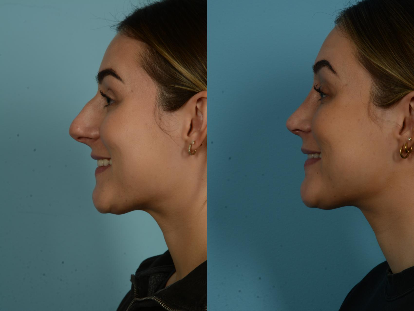 Before & After Rhinoplasty by Dr. Sinno Case 1069 Left Side View in Chicago, IL