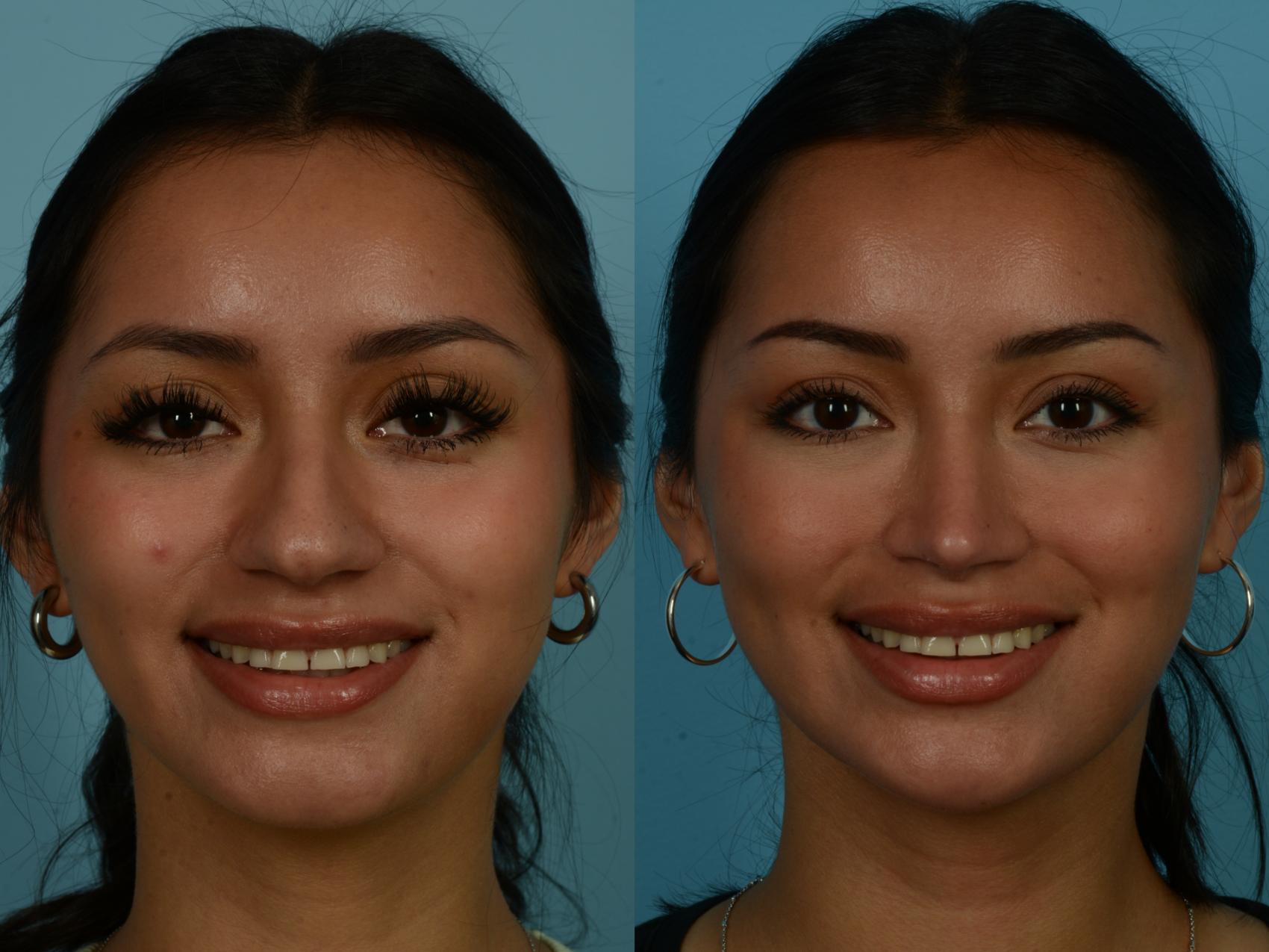 Before & After Rhinoplasty by Dr. Sinno Case 1071 Front View in Chicago, IL