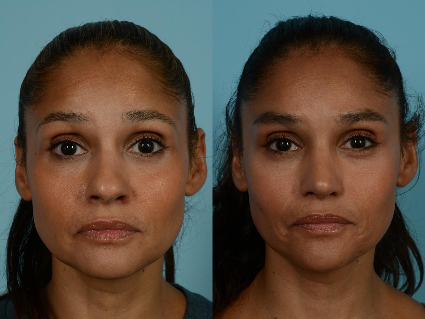 Before & After Rhinoplasty by Dr. Sinno Case 1097 Front View in Chicago, IL