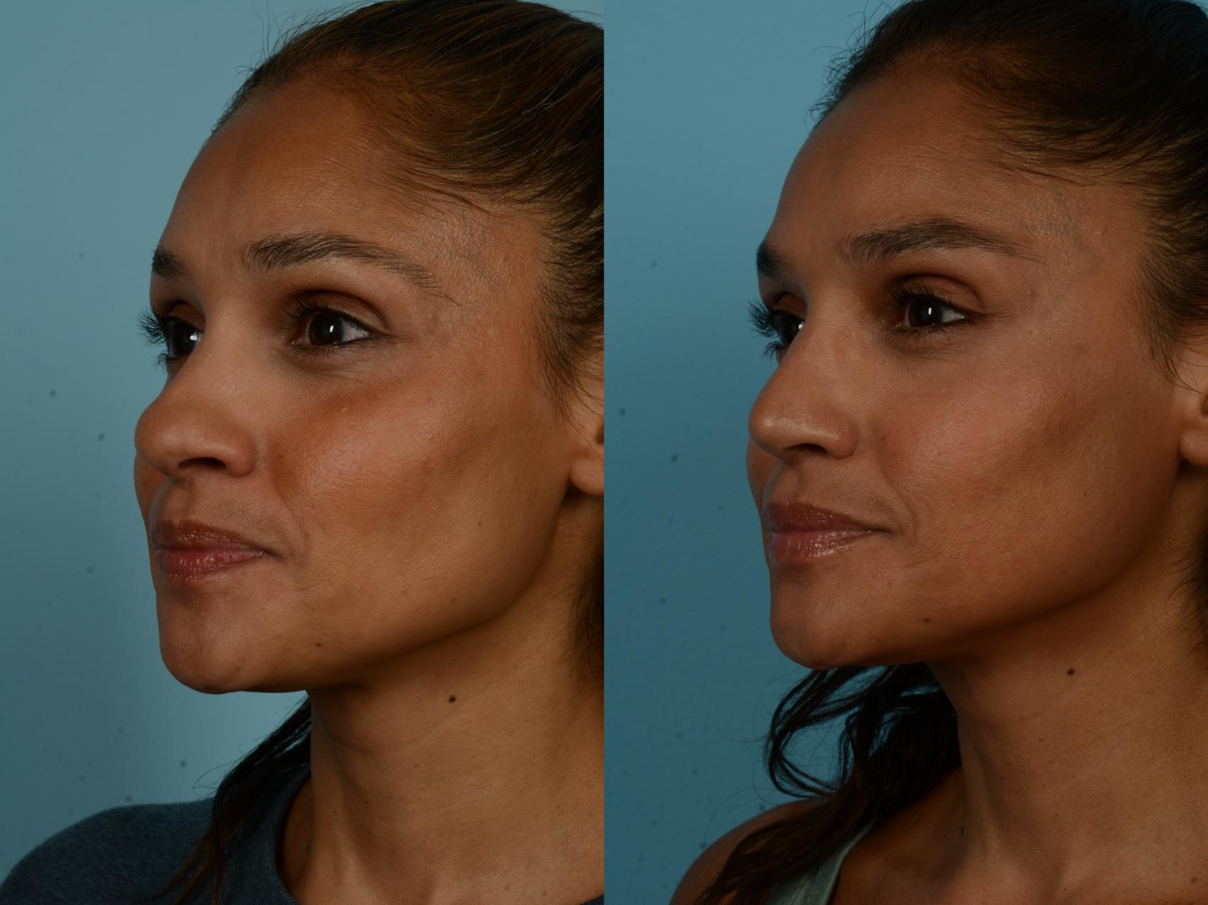 Before & After Rhinoplasty by Dr. Sinno Case 1097 Left Oblique View in Chicago, IL