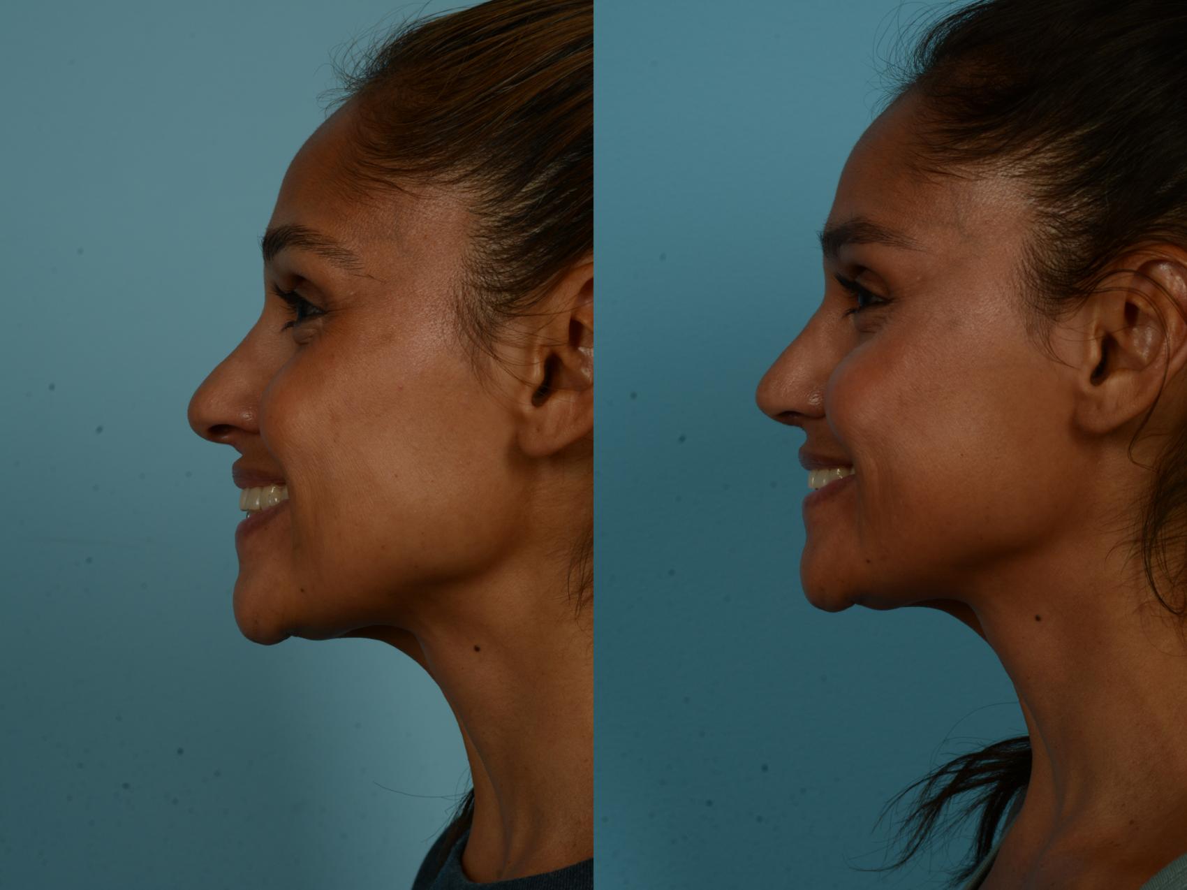 Before & After Rhinoplasty by Dr. Sinno Case 1097 Left Side View in Chicago, IL