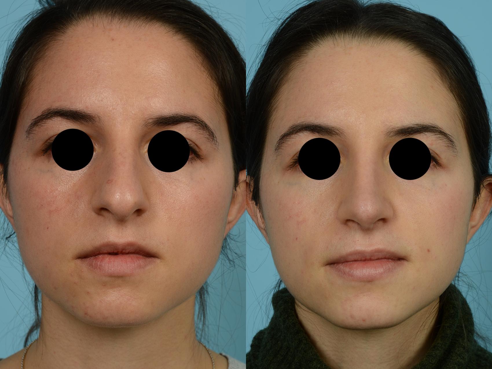 Dr. Sinno Rhinoplasty in Chicago, Illinois