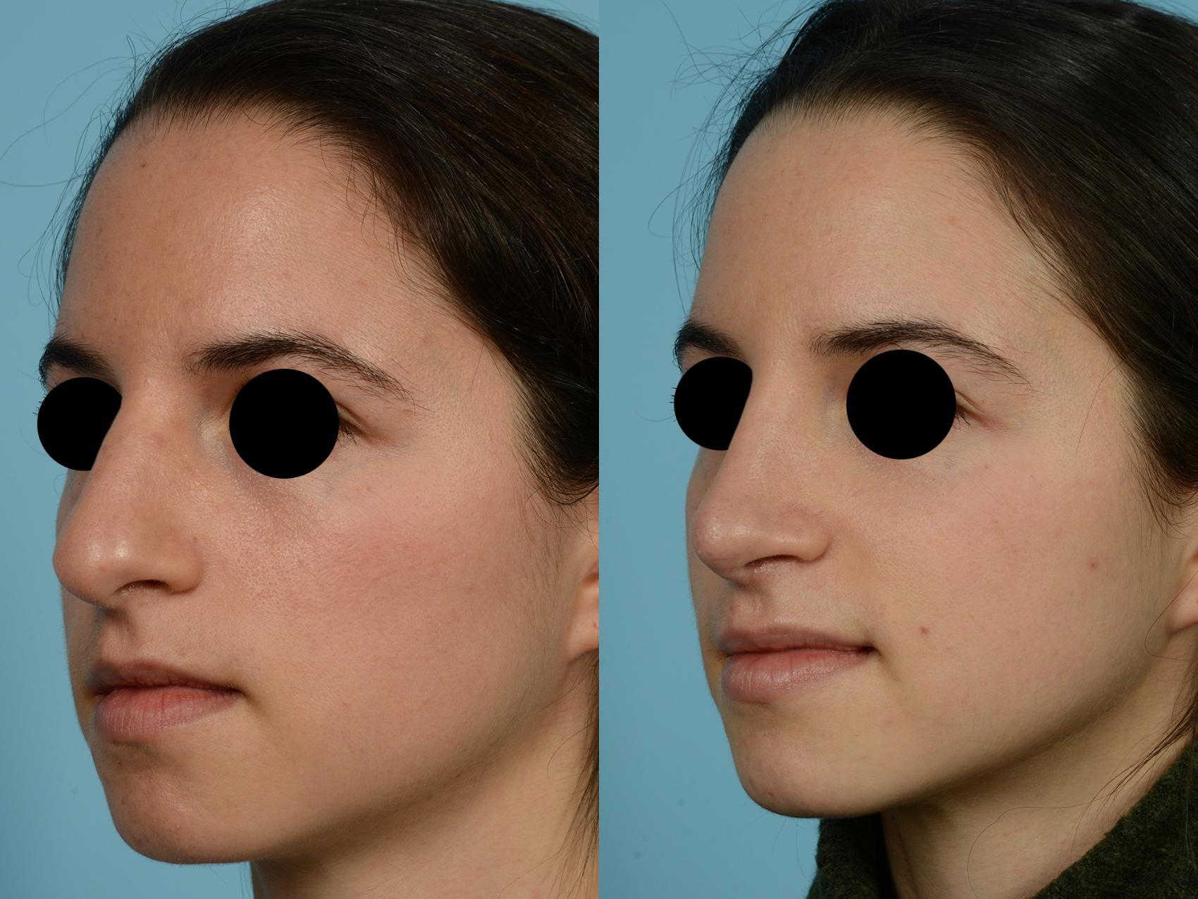 Dr. Sinno Rhinoplasty in Chicago, Illinois