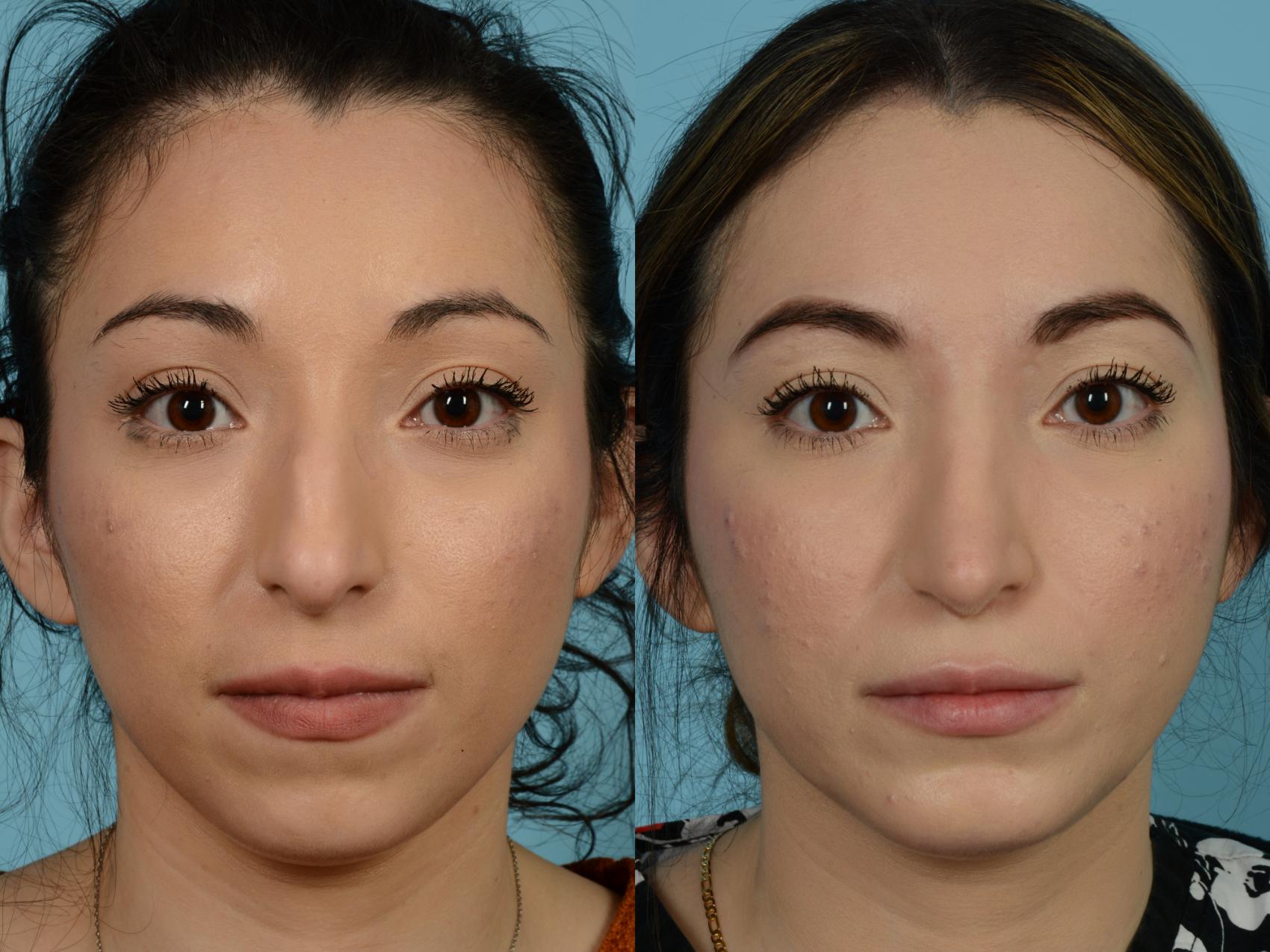 Dr. Sinno Rhinoplasty in Chicago, Illinois