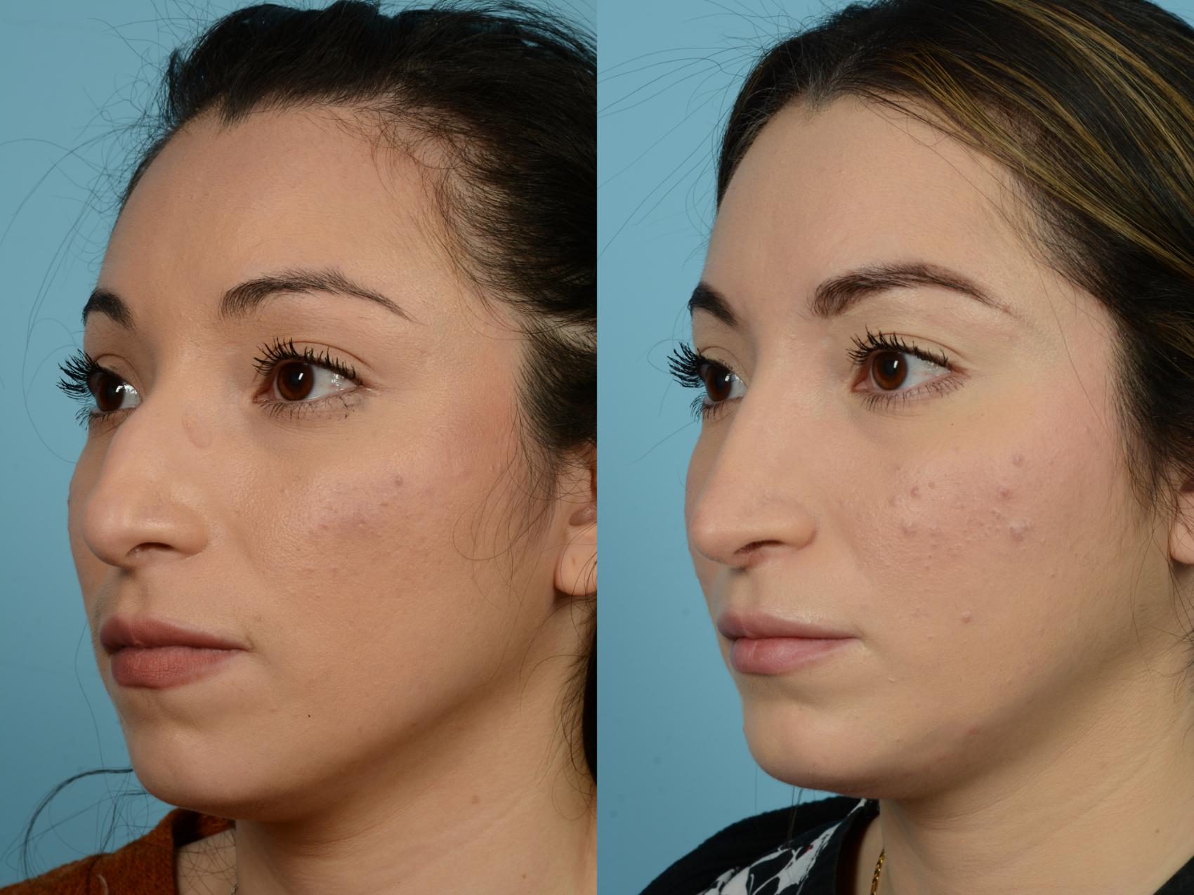 Dr. Sinno Rhinoplasty in Chicago, Illinois