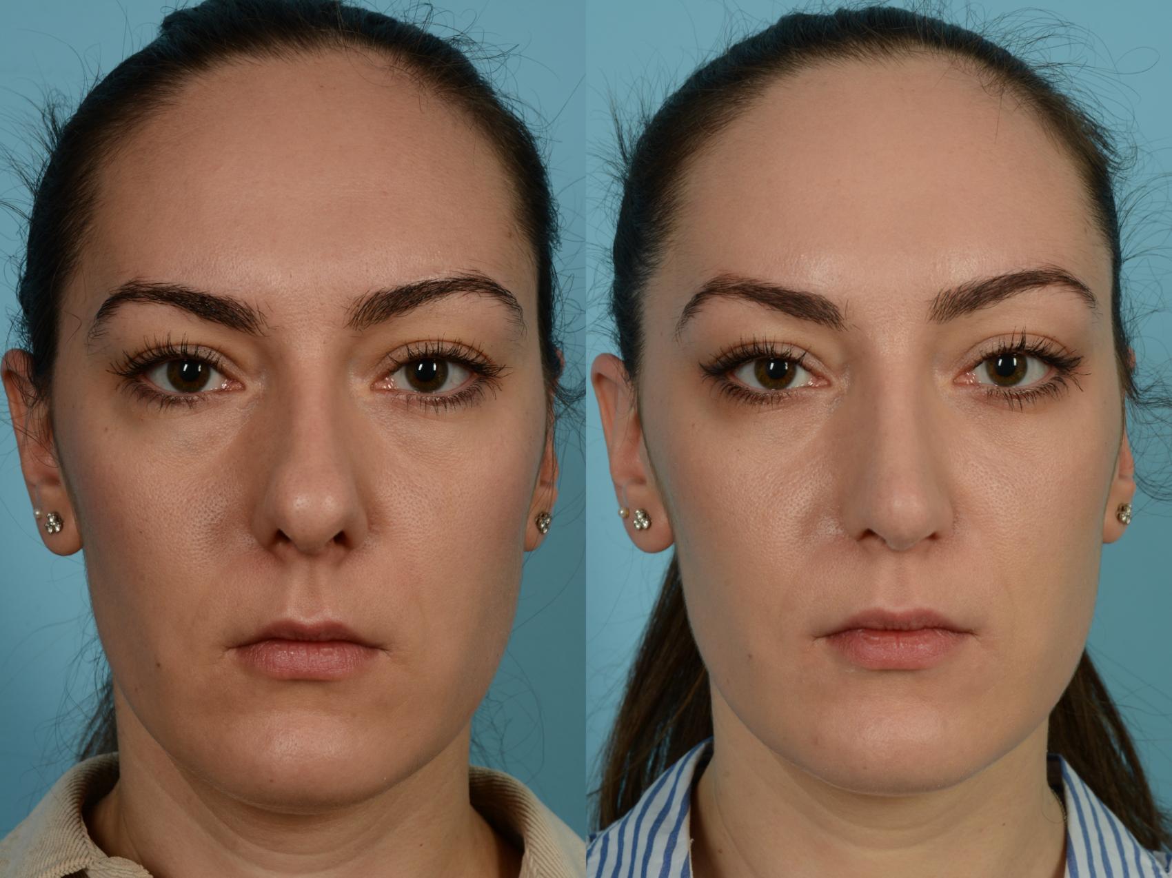 Dr. Sinno Rhinoplasty in Chicago, Illinois