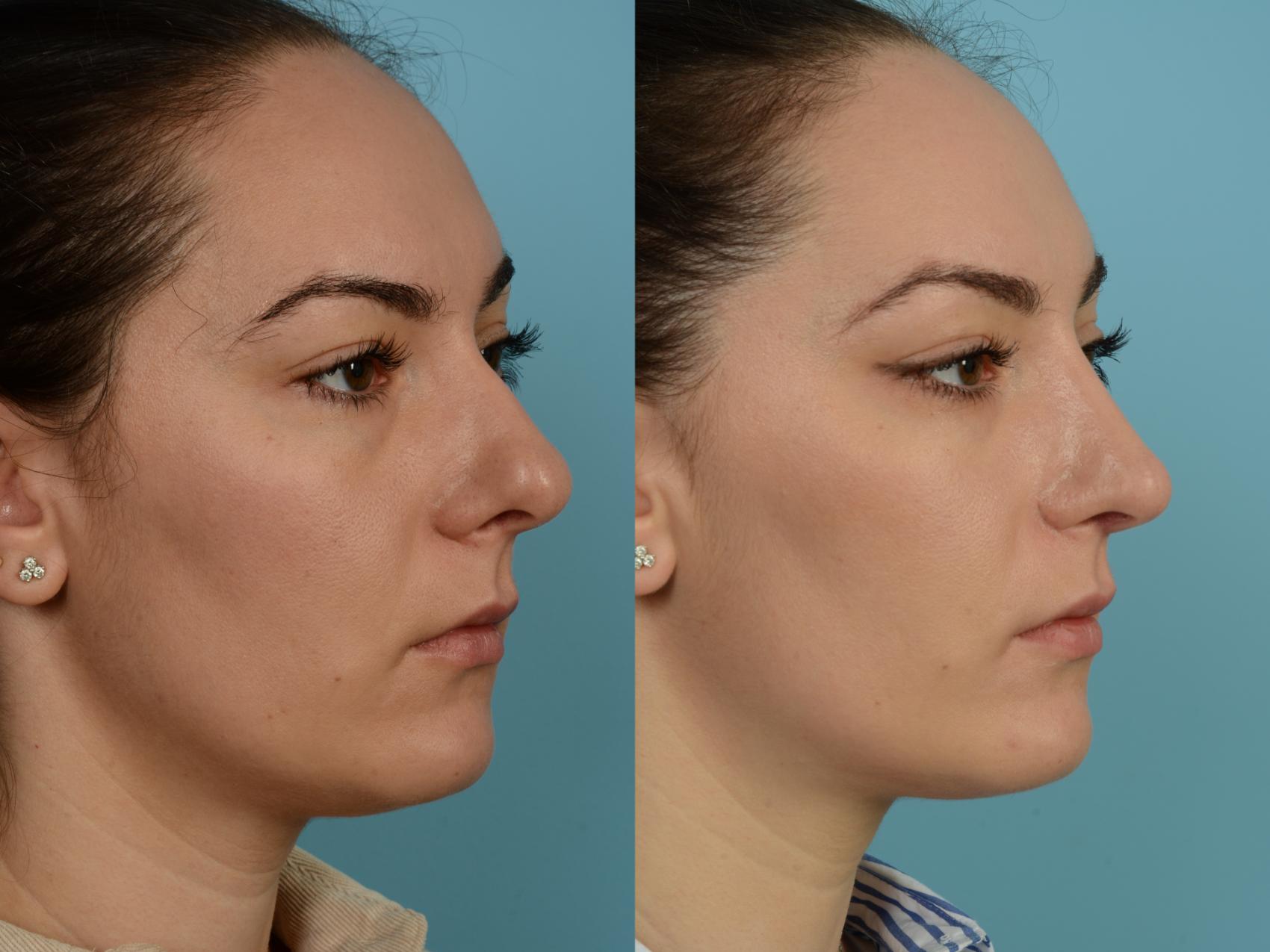 Dr. Sinno Rhinoplasty in Chicago, Illinois