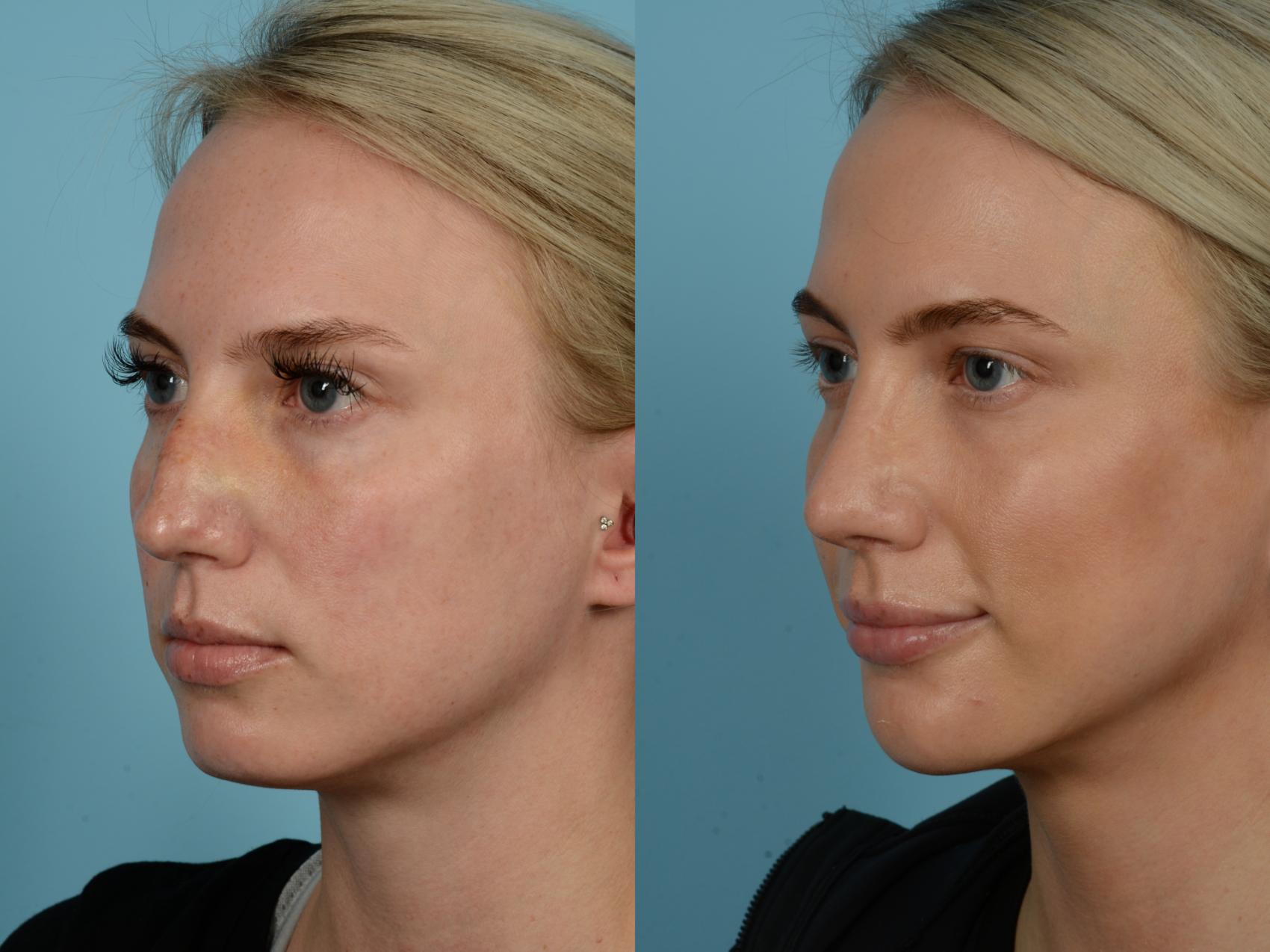 Rhinoplasty By Dr Sinno Before And After Pictures Case Chicago