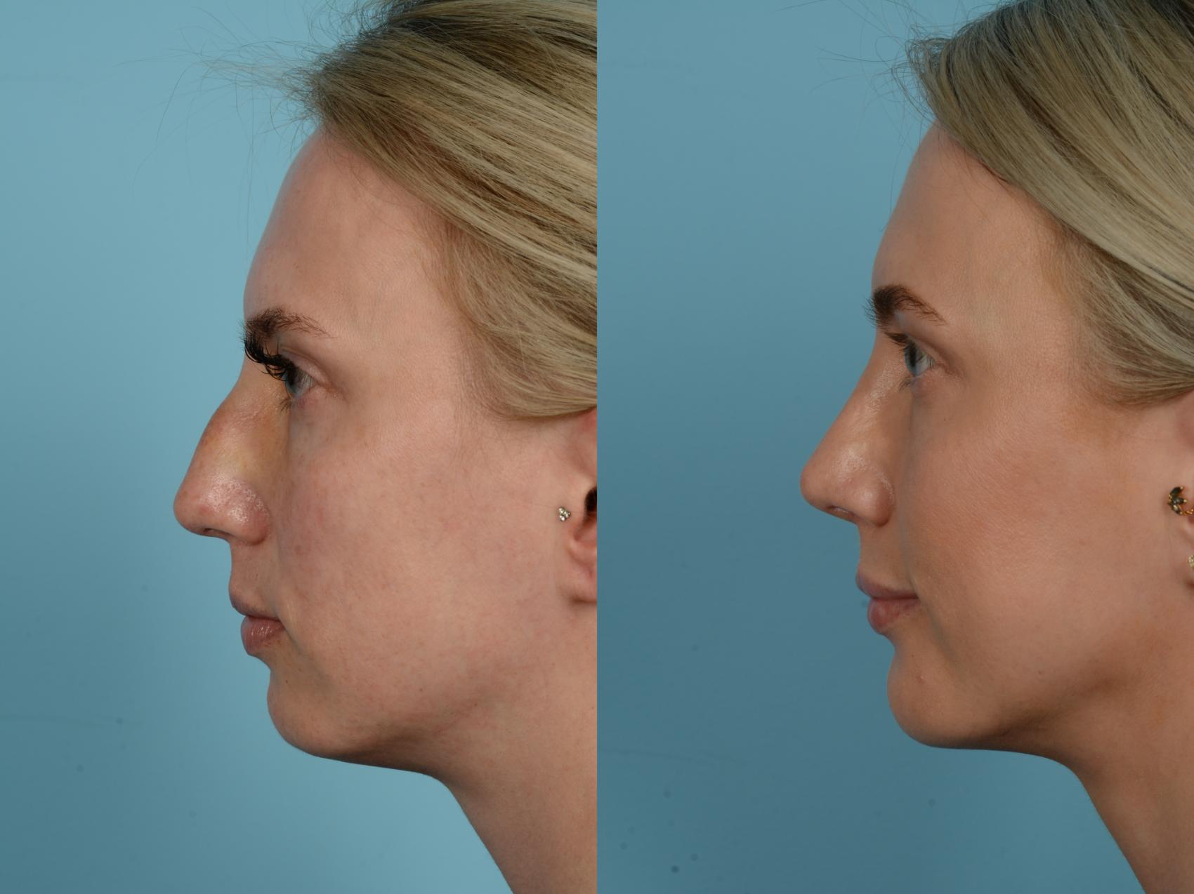 Dr. Sinno Rhinoplasty in Chicago, Illinois