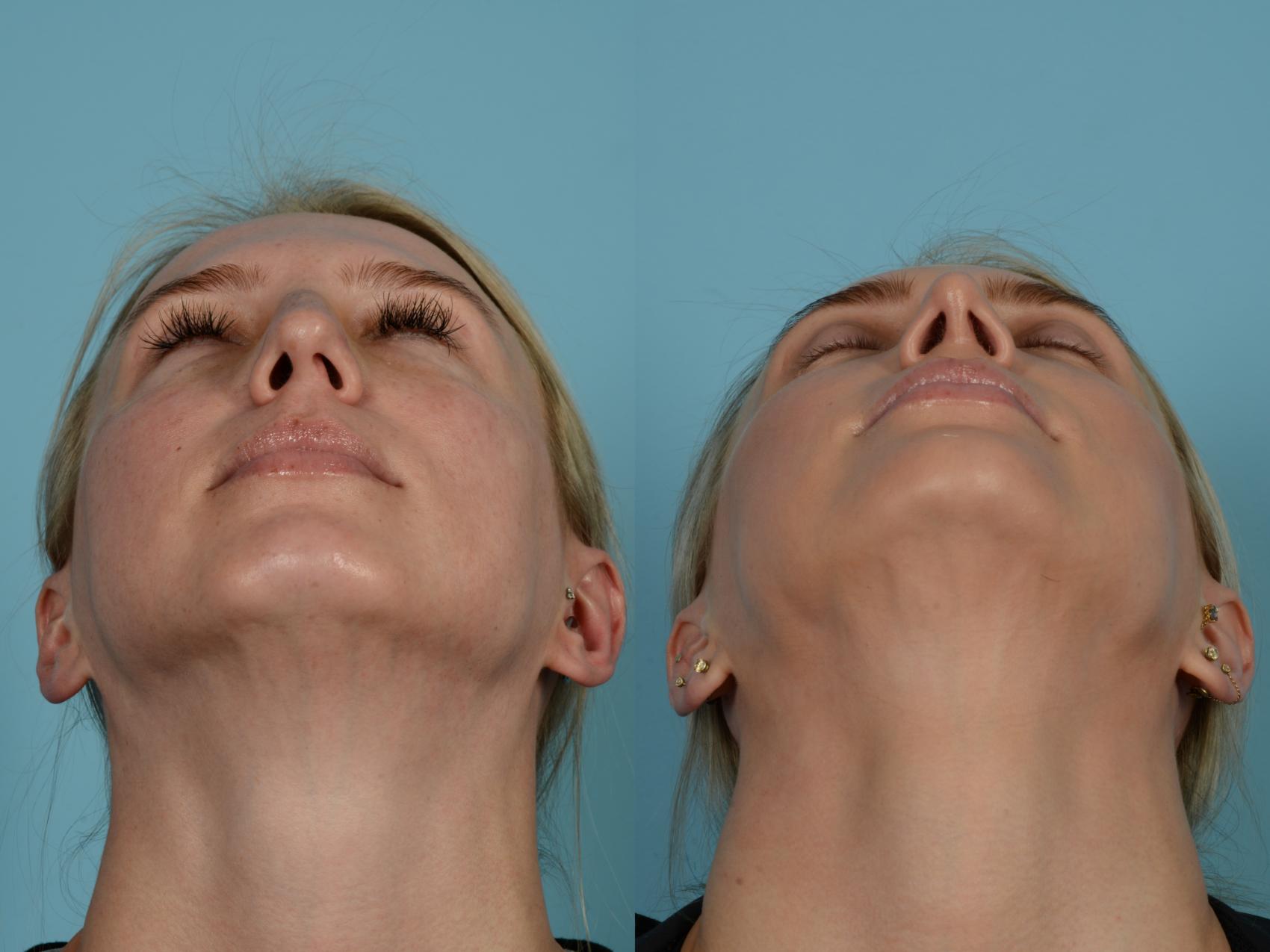 Dr. Sinno Rhinoplasty in Chicago, Illinois