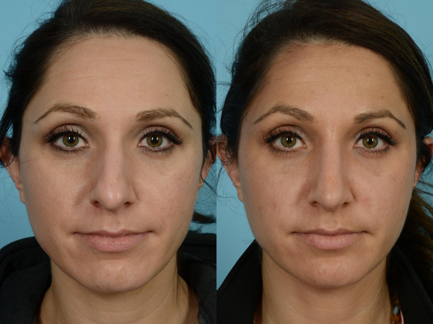 Dr. Sinno Rhinoplasty in Chicago, Illinois