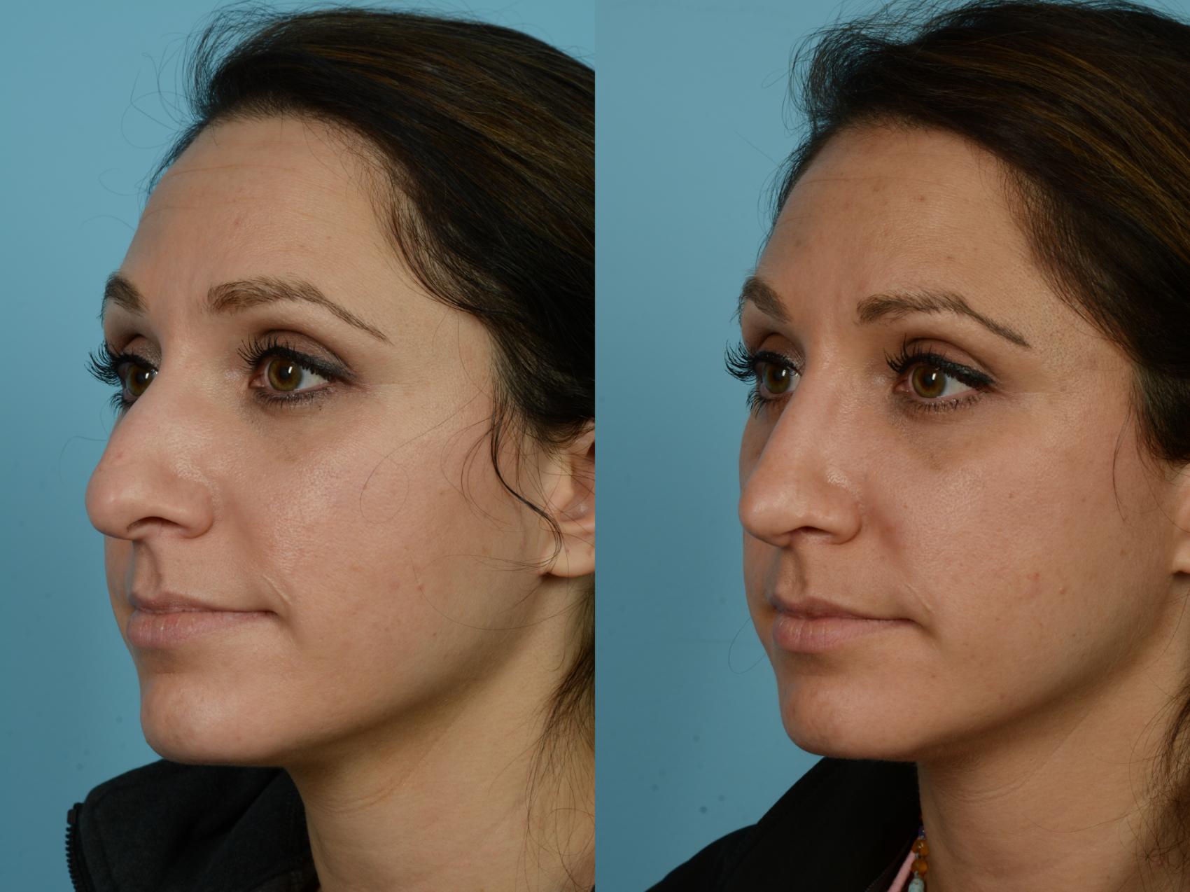 Dr. Sinno Rhinoplasty in Chicago, Illinois