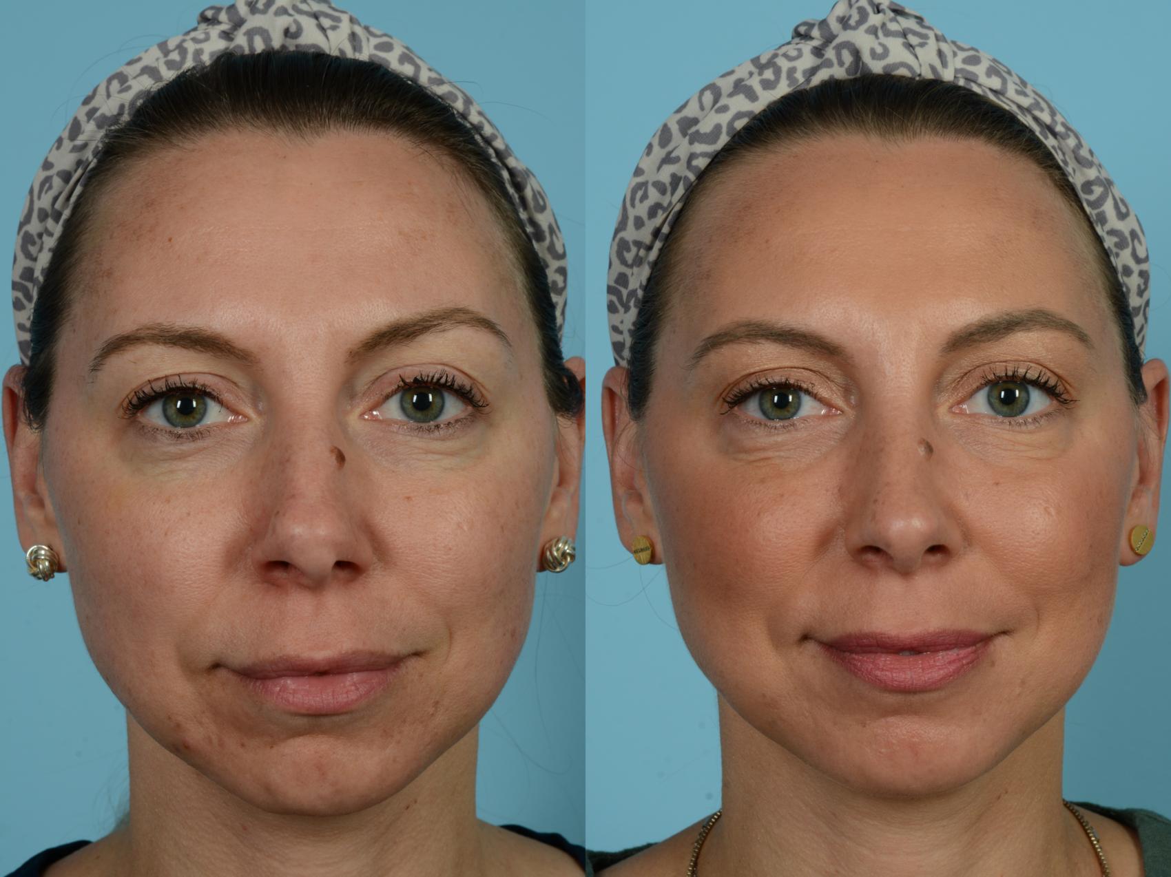 Dr. Sinno Rhinoplasty in Chicago, Illinois