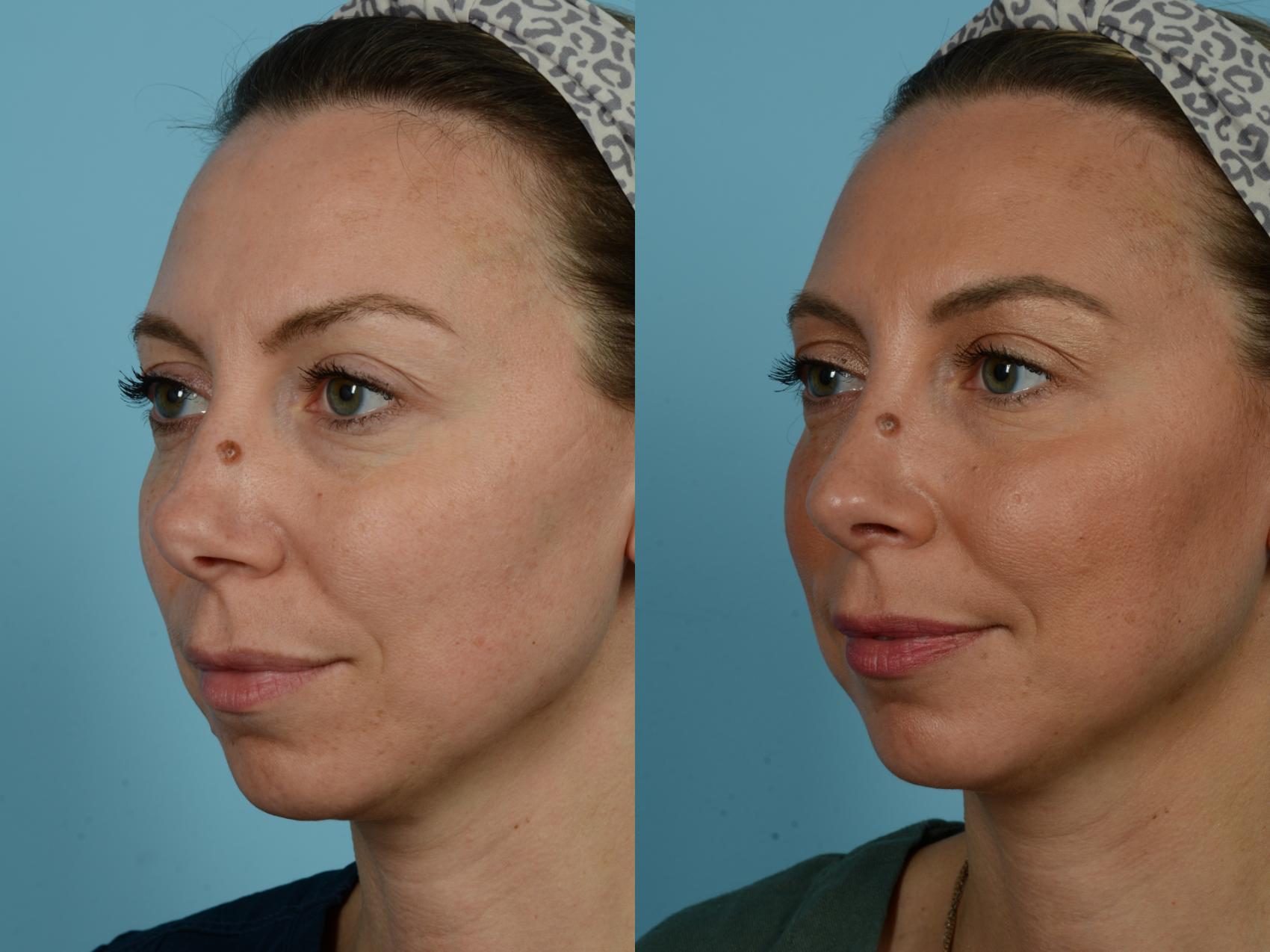 Dr. Sinno Rhinoplasty in Chicago, Illinois