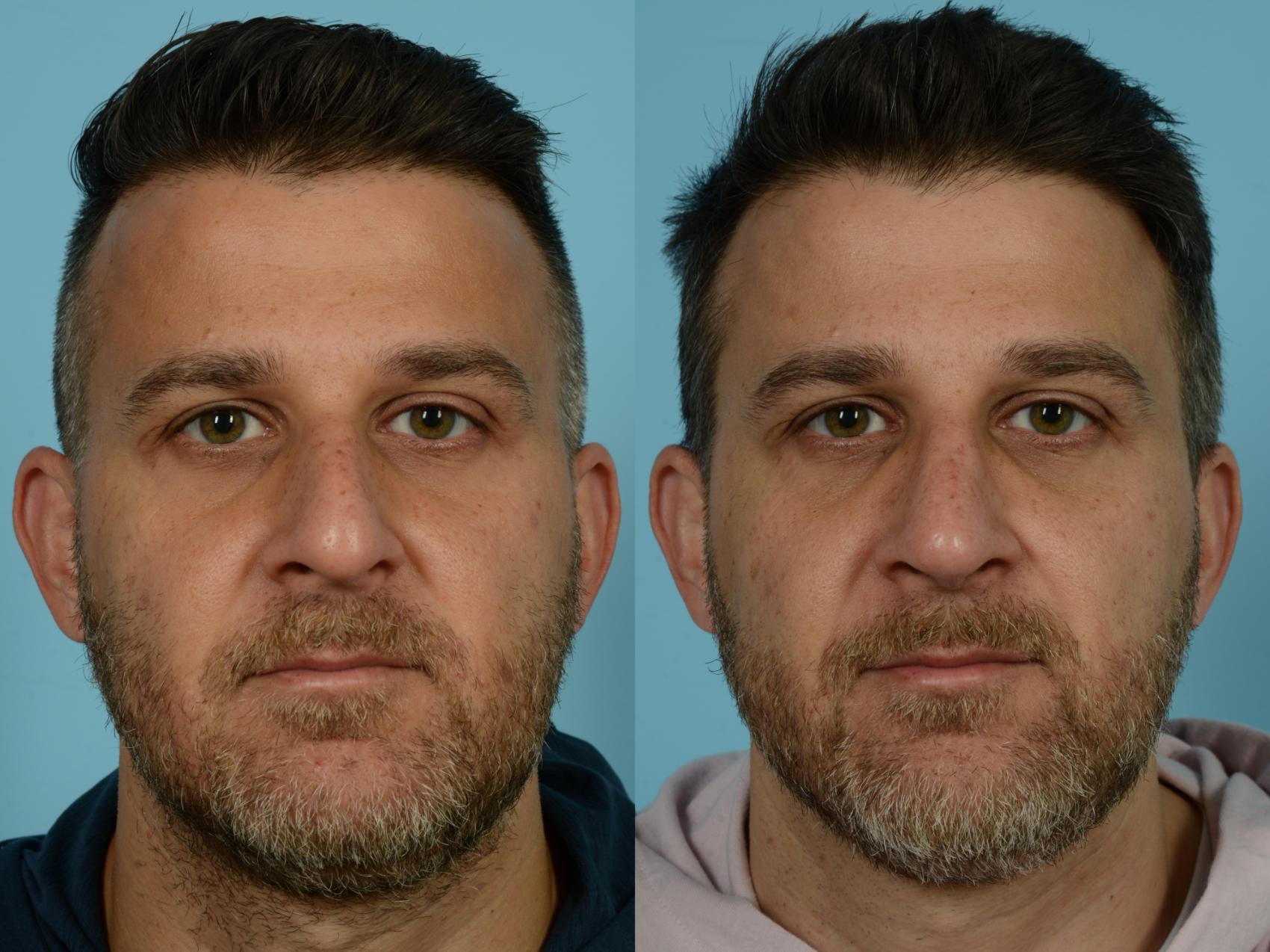 Before & After Rhinoplasty by Dr. Sinno Case 779 Front View in Chicago, IL