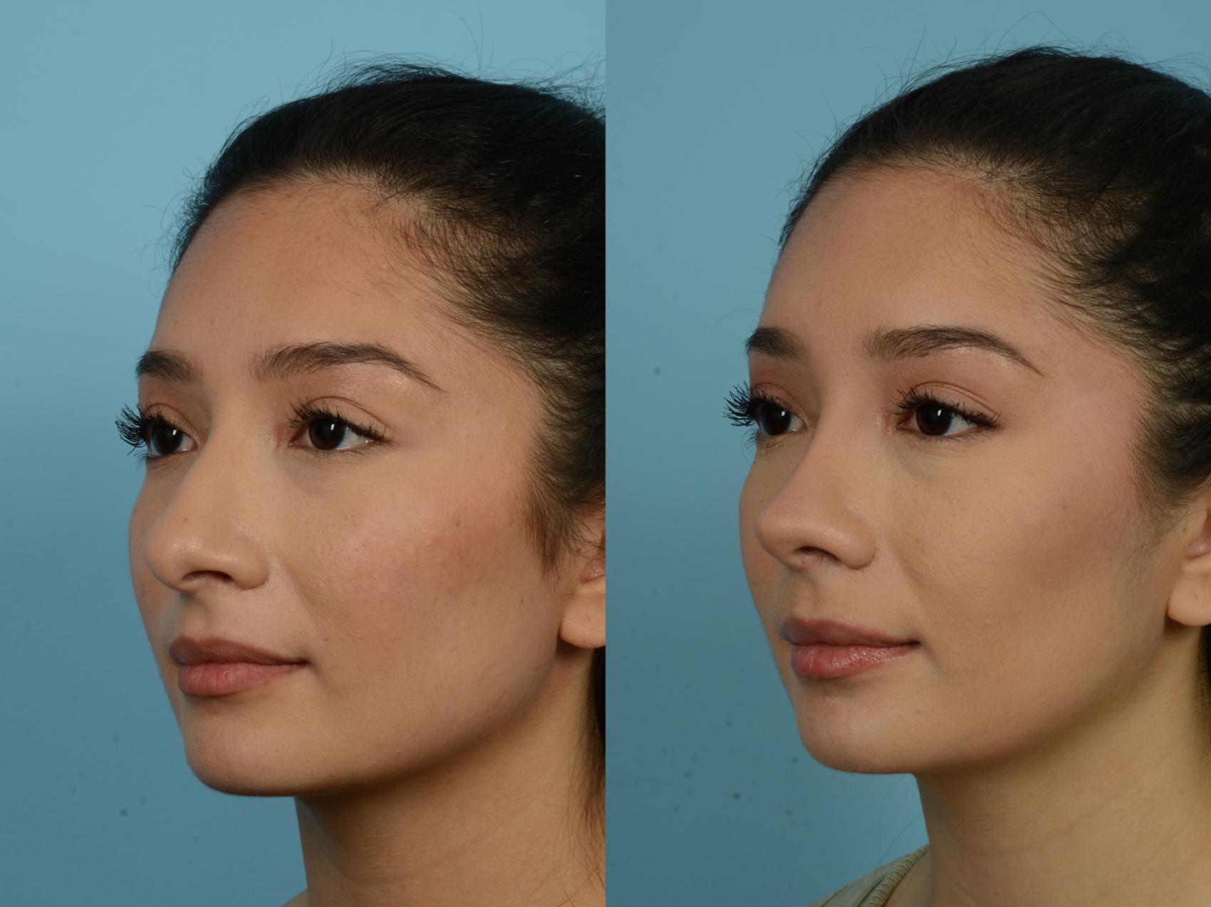 Before & After Rhinoplasty by Dr. Sinno Case 787 Left Oblique View in Chicago, IL