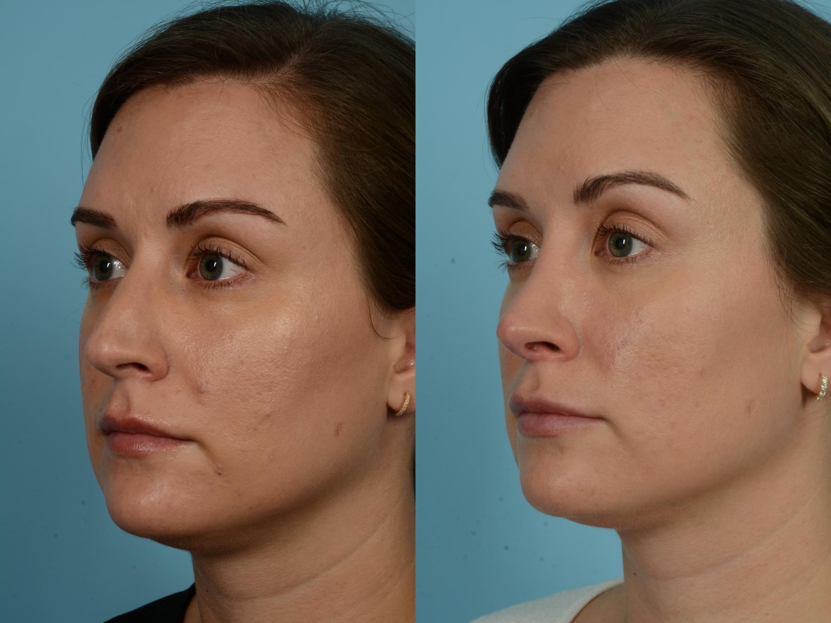 Before & After Rhinoplasty by Dr. Sinno Case 791 Left Oblique View in Chicago, IL