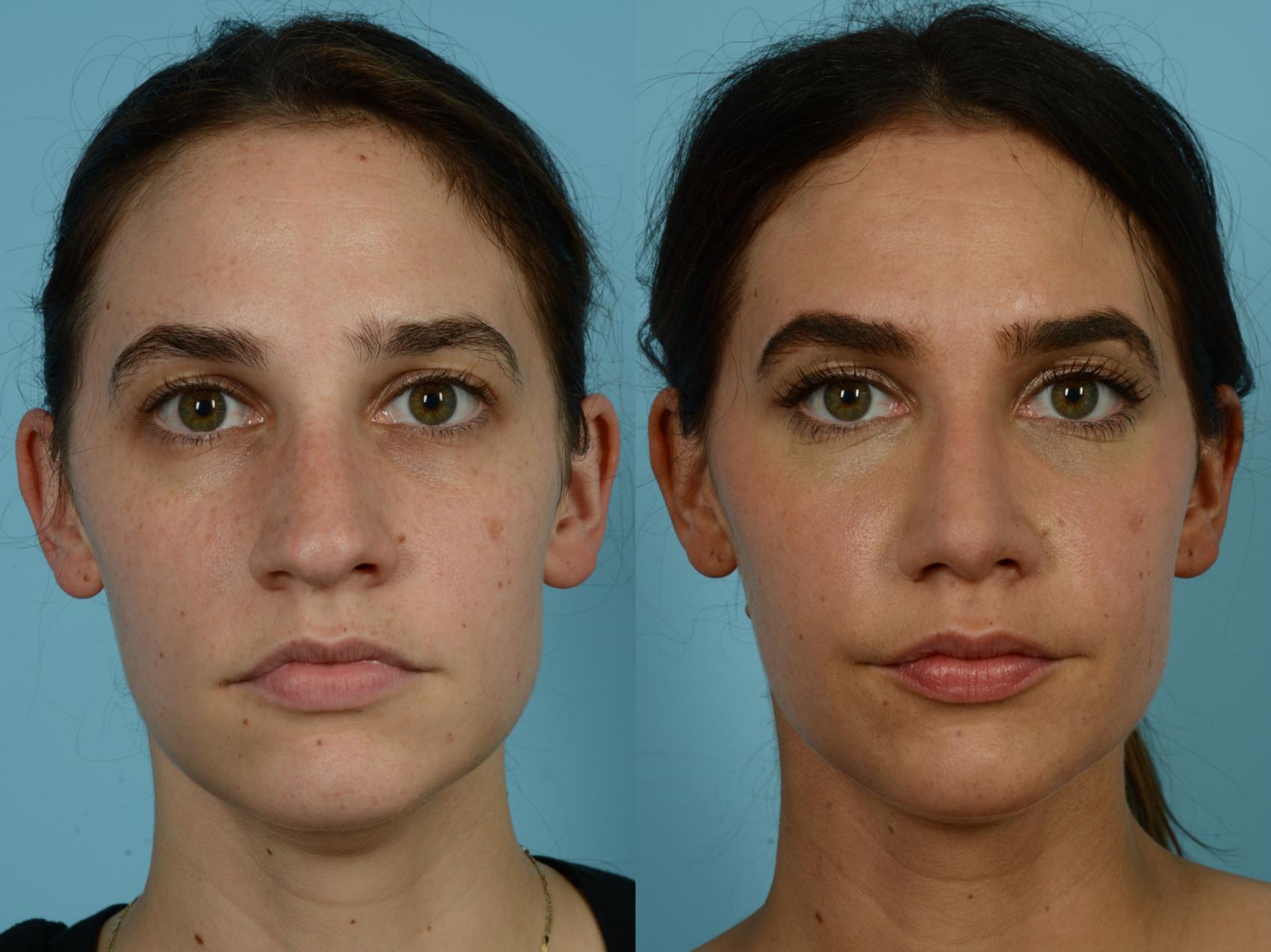Before & After Rhinoplasty by Dr. Sinno Case 792 Front View in Chicago, IL