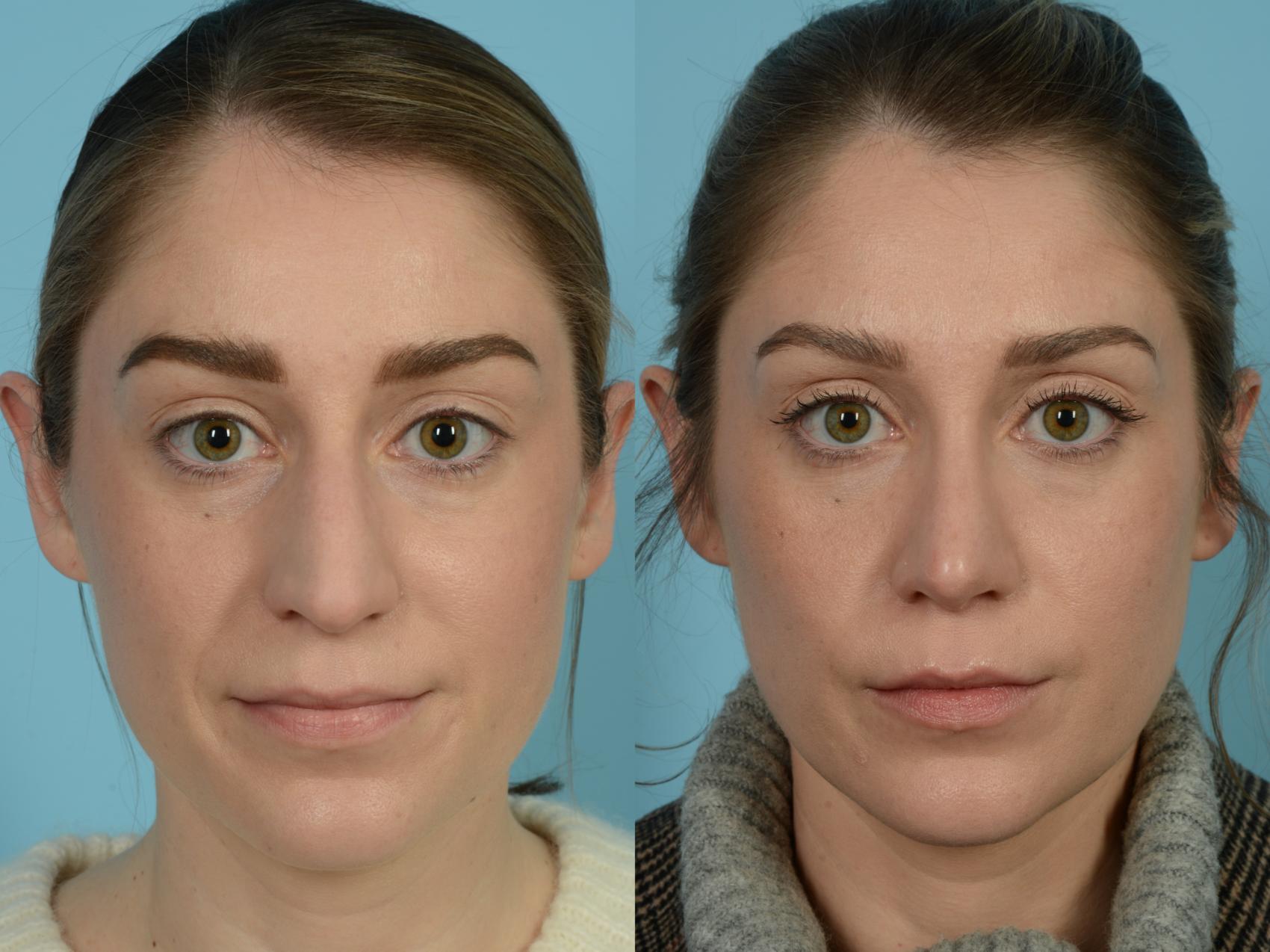Before & After Rhinoplasty by Dr. Sinno Case 807 Front View in Chicago, IL