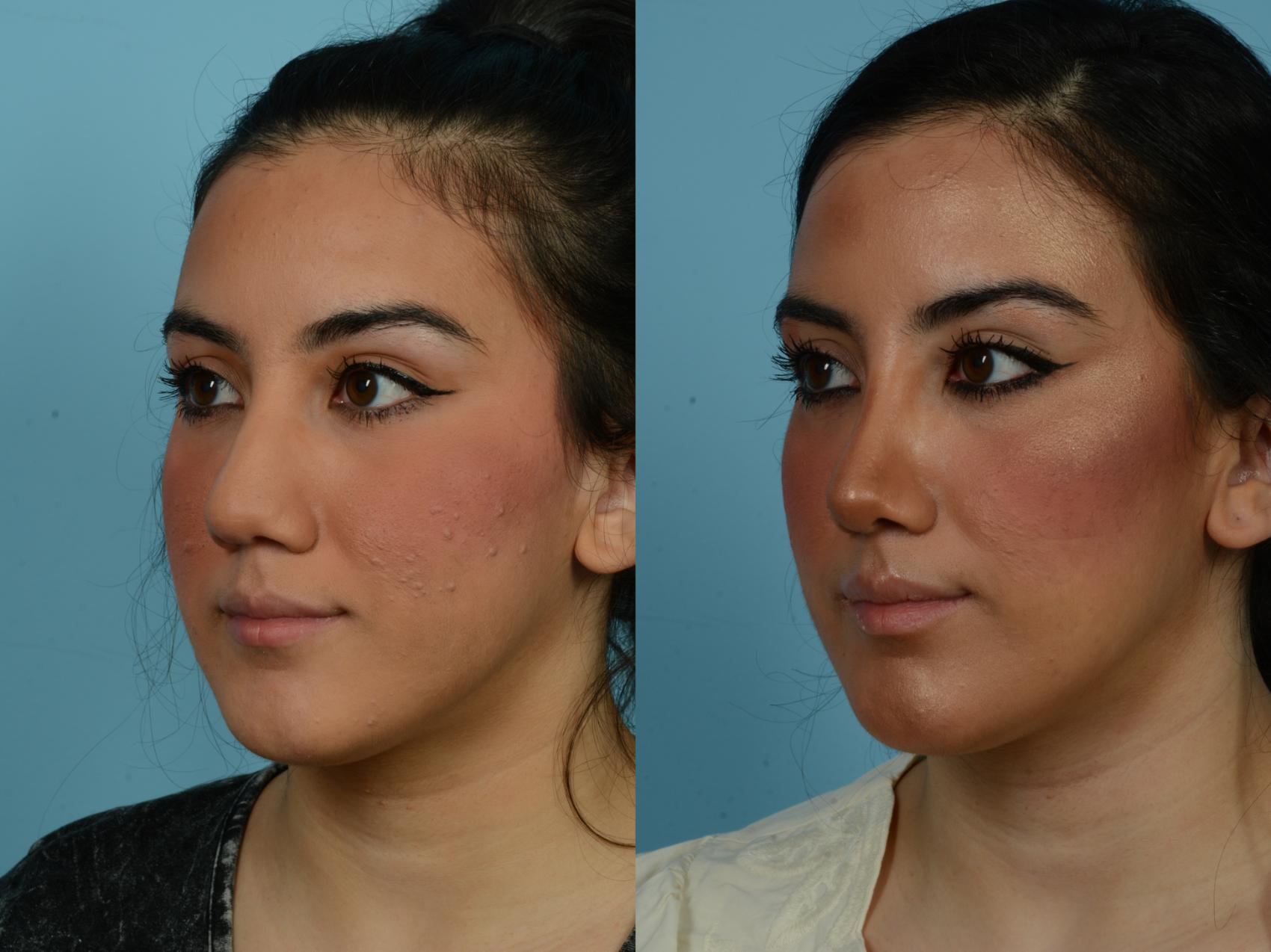 Before & After Rhinoplasty by Dr. Sinno Case 813 Left Oblique View in Chicago, IL