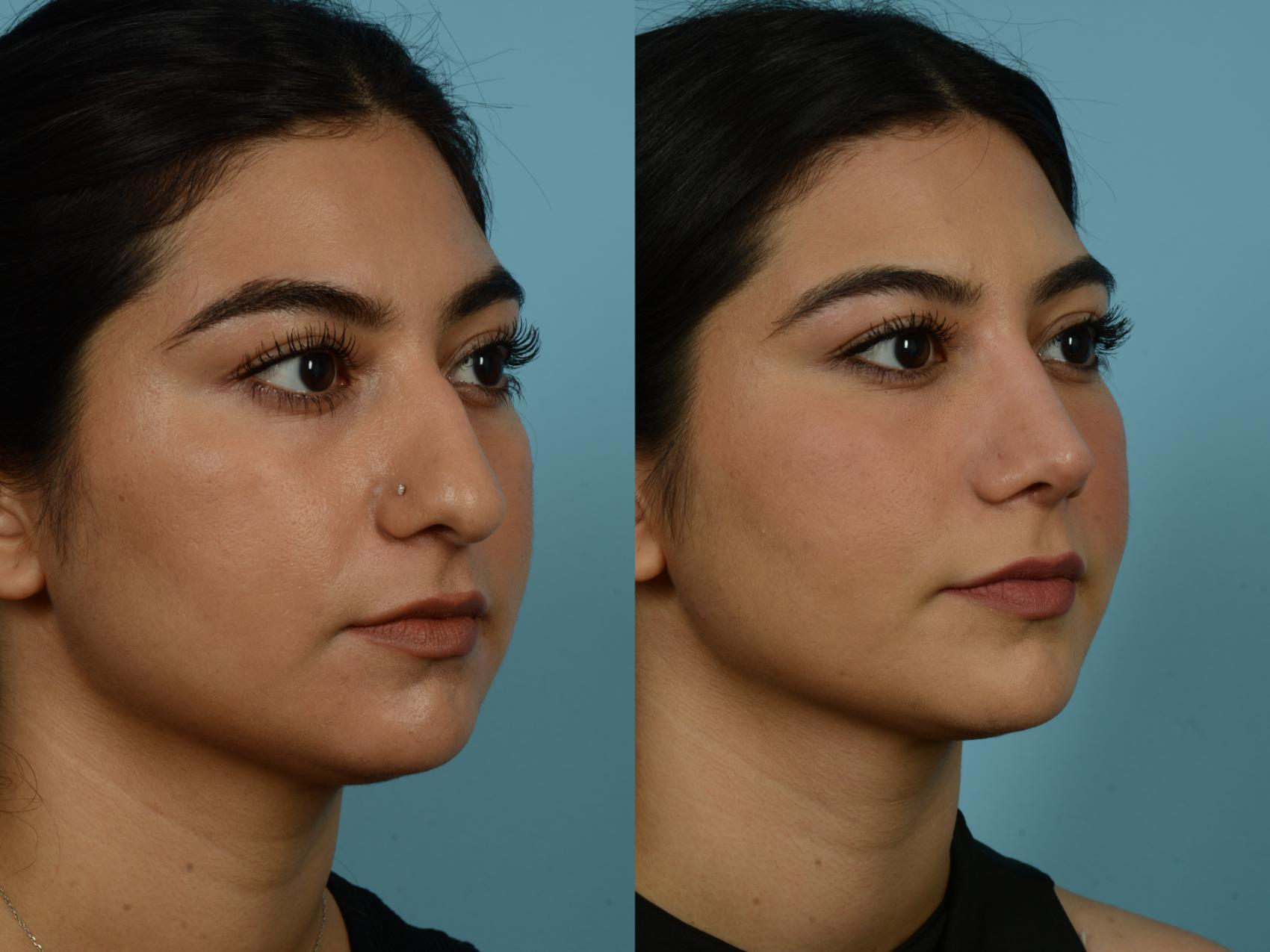 Before & After Rhinoplasty by Dr. Sinno Case 846 Right Oblique View in Chicago, IL