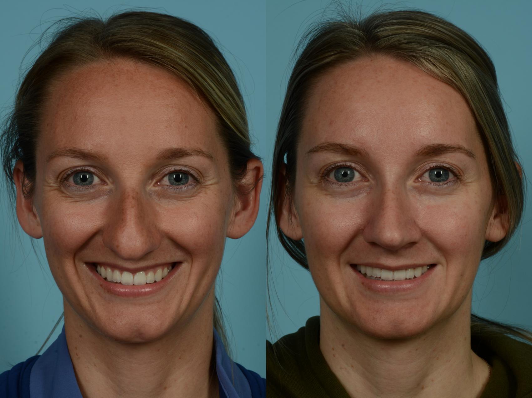 Before & After Rhinoplasty by Dr. Sinno Case 847 Front View in Chicago, IL