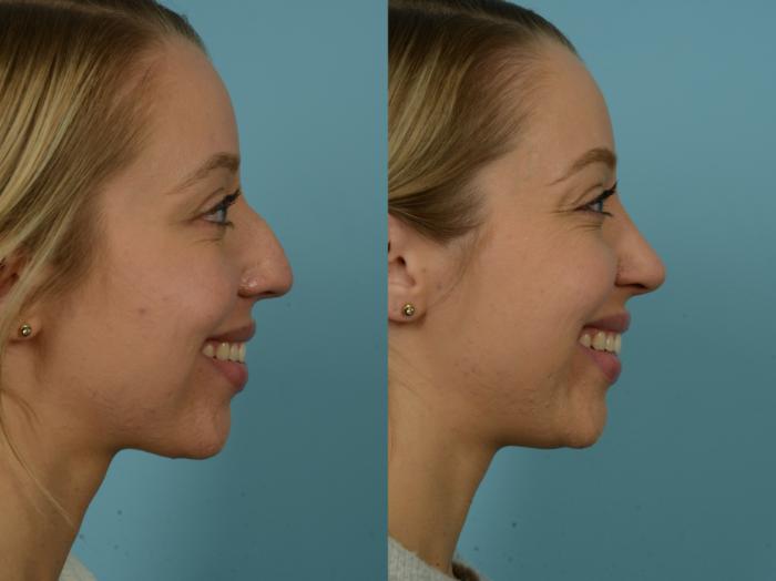 Before & After Rhinoplasty by Dr. Sinno Case 868 Right Side View in Chicago, IL