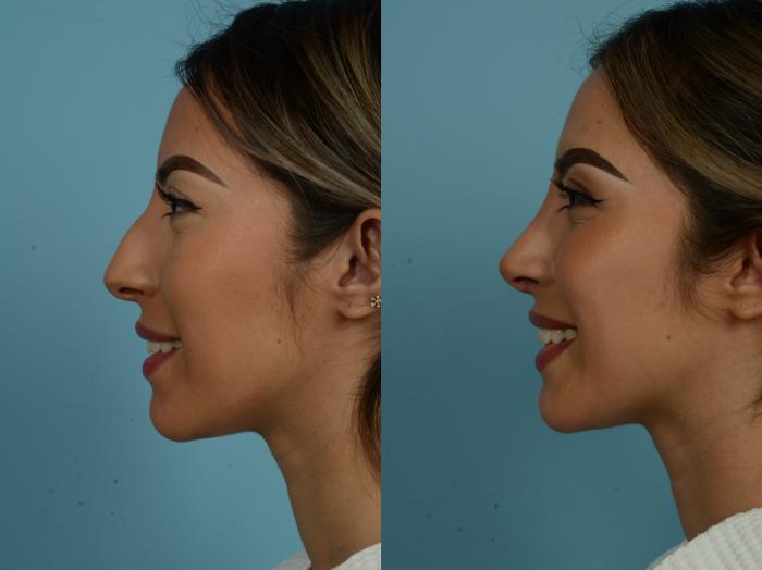 Before & After Rhinoplasty by Dr. Sinno Case 879 Left Side View in Chicago, IL