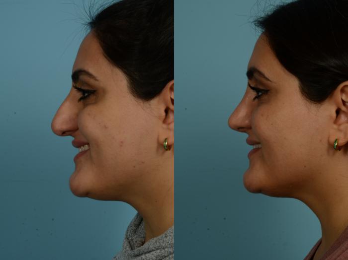 Before & After Rhinoplasty by Dr. Sinno Case 881 Left Side View in Chicago, IL
