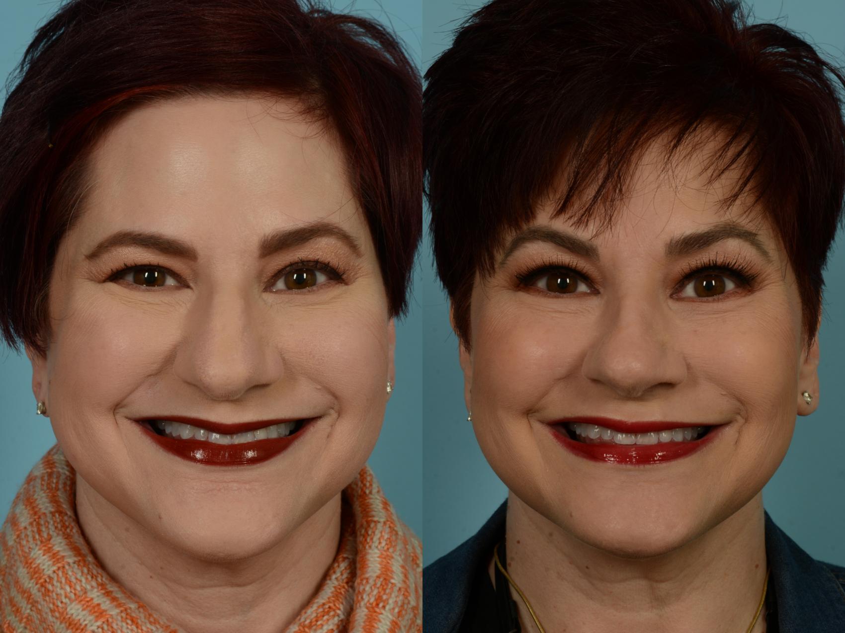 Before & After Rhinoplasty by Dr. Sinno Case 883 Front View in Chicago, IL