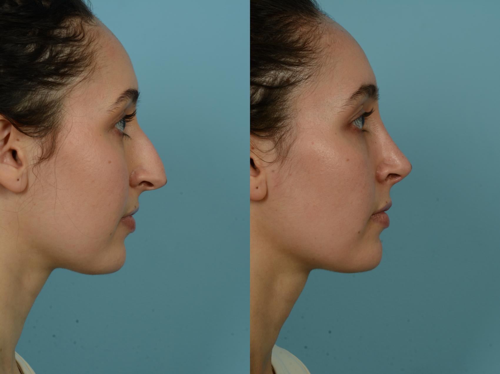 Before & After Rhinoplasty by Dr. Sinno Case 891 Right Side View in Chicago, IL