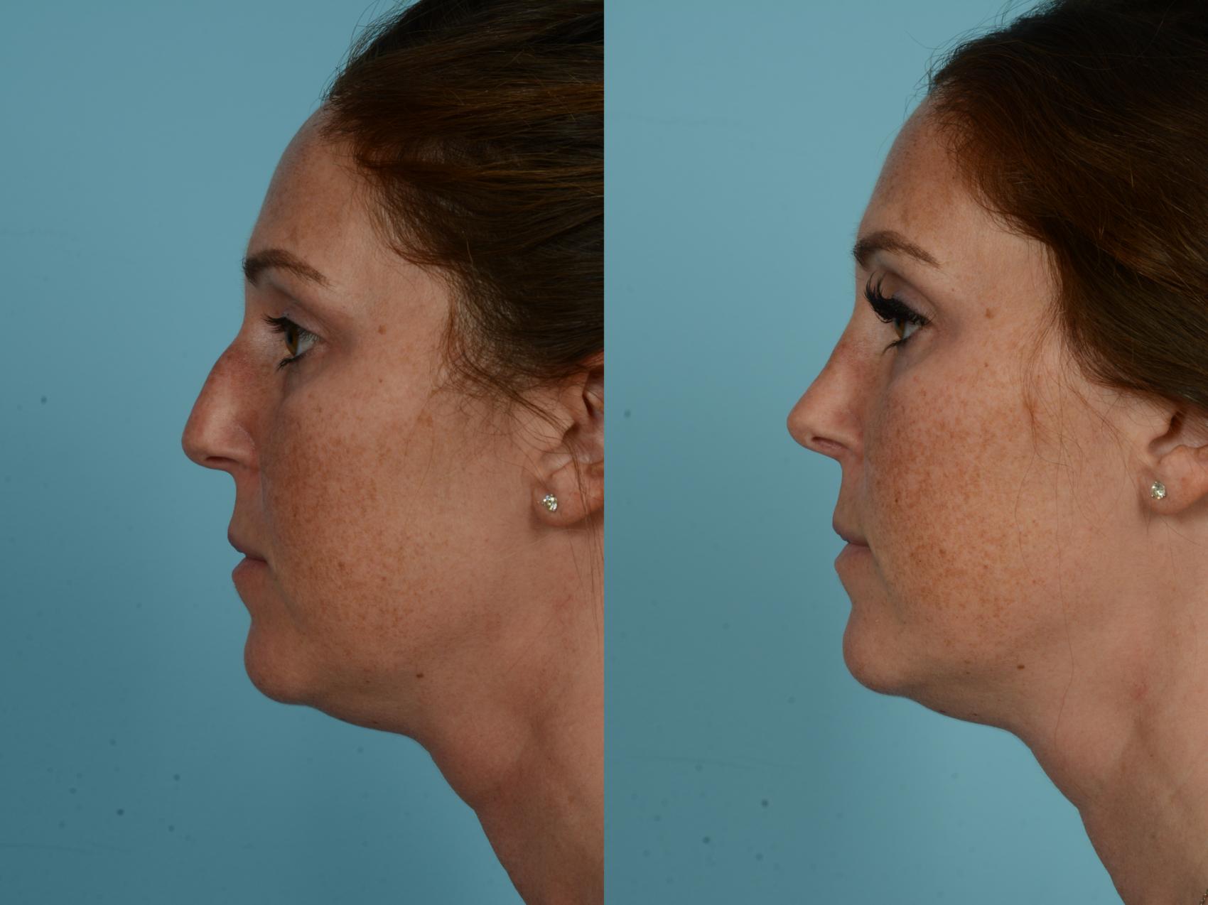 Before & After Rhinoplasty by Dr. Sinno Case 898 Left Side View in Chicago, IL