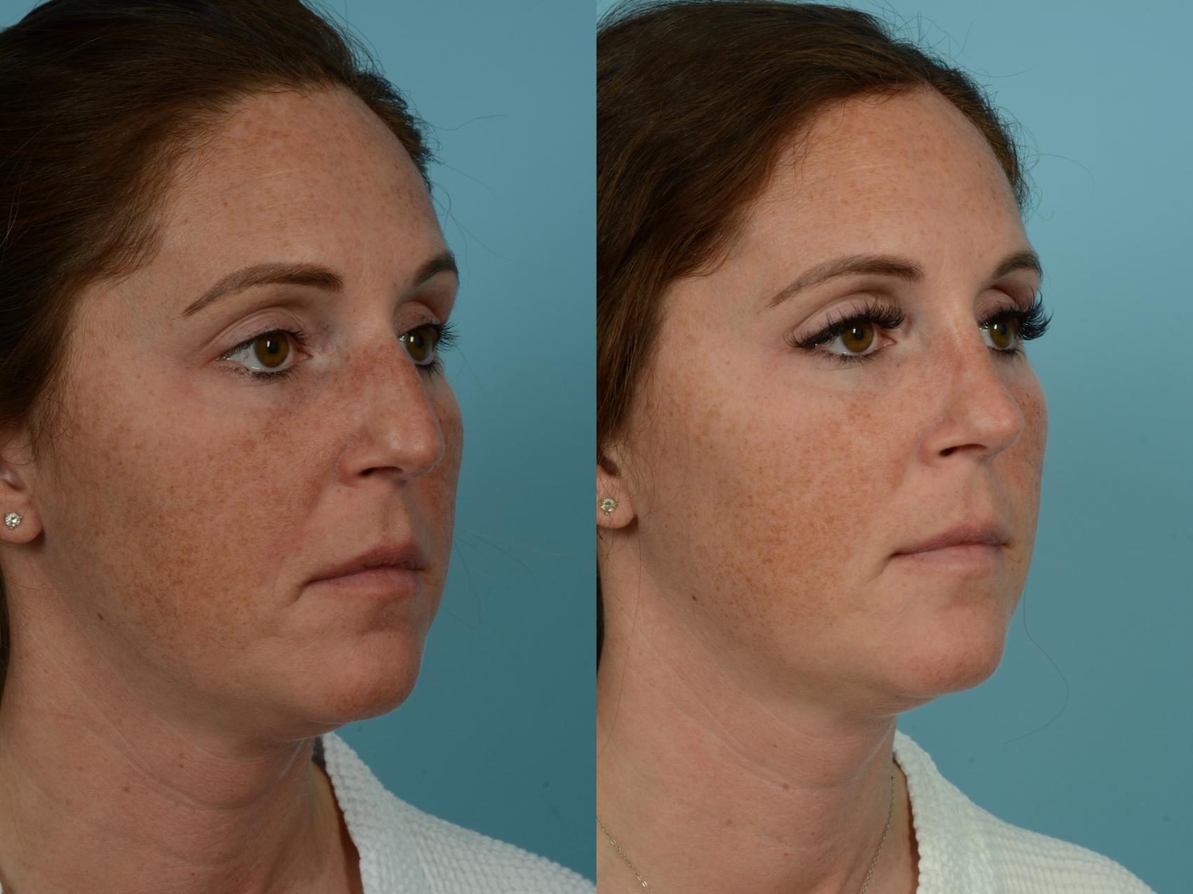 Before & After Rhinoplasty by Dr. Sinno Case 898 Right Oblique View in Chicago, IL