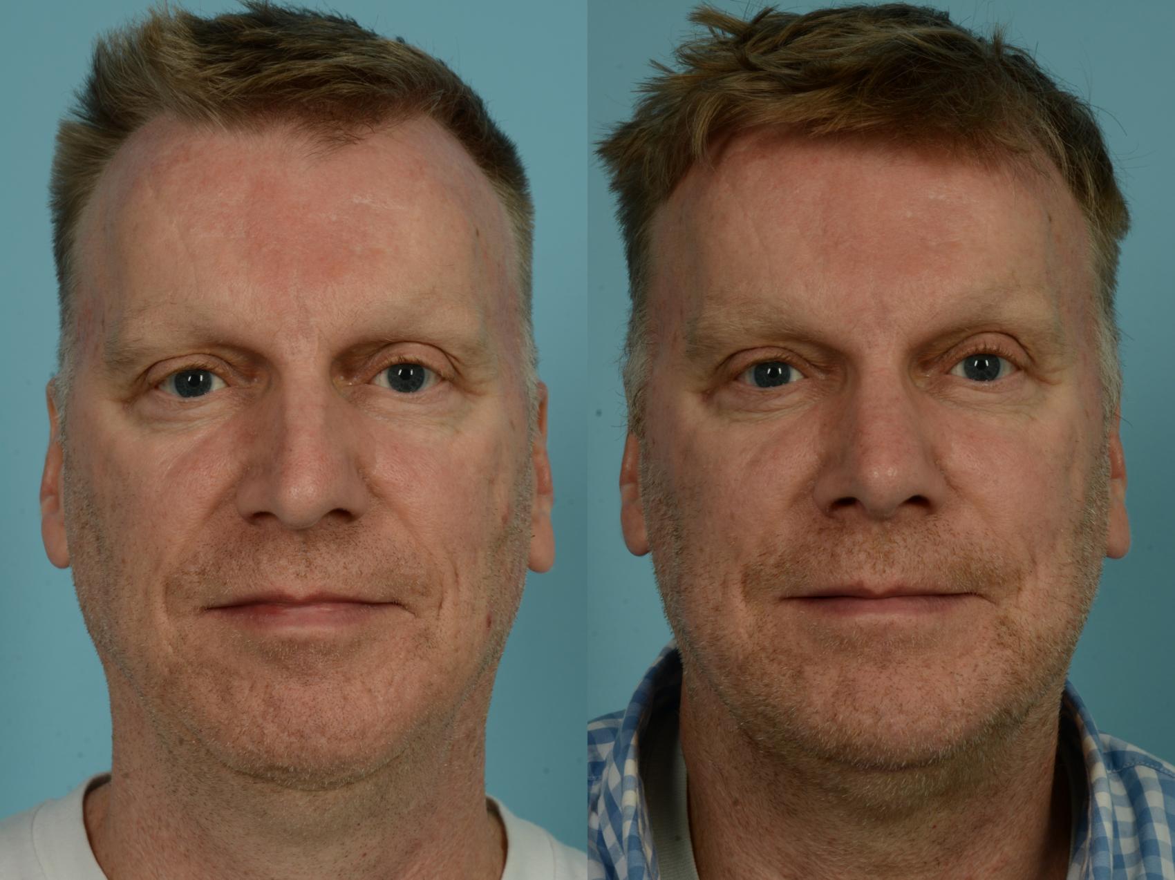 Before & After Rhinoplasty by Dr. Sinno Case 907 Front View in Chicago, IL