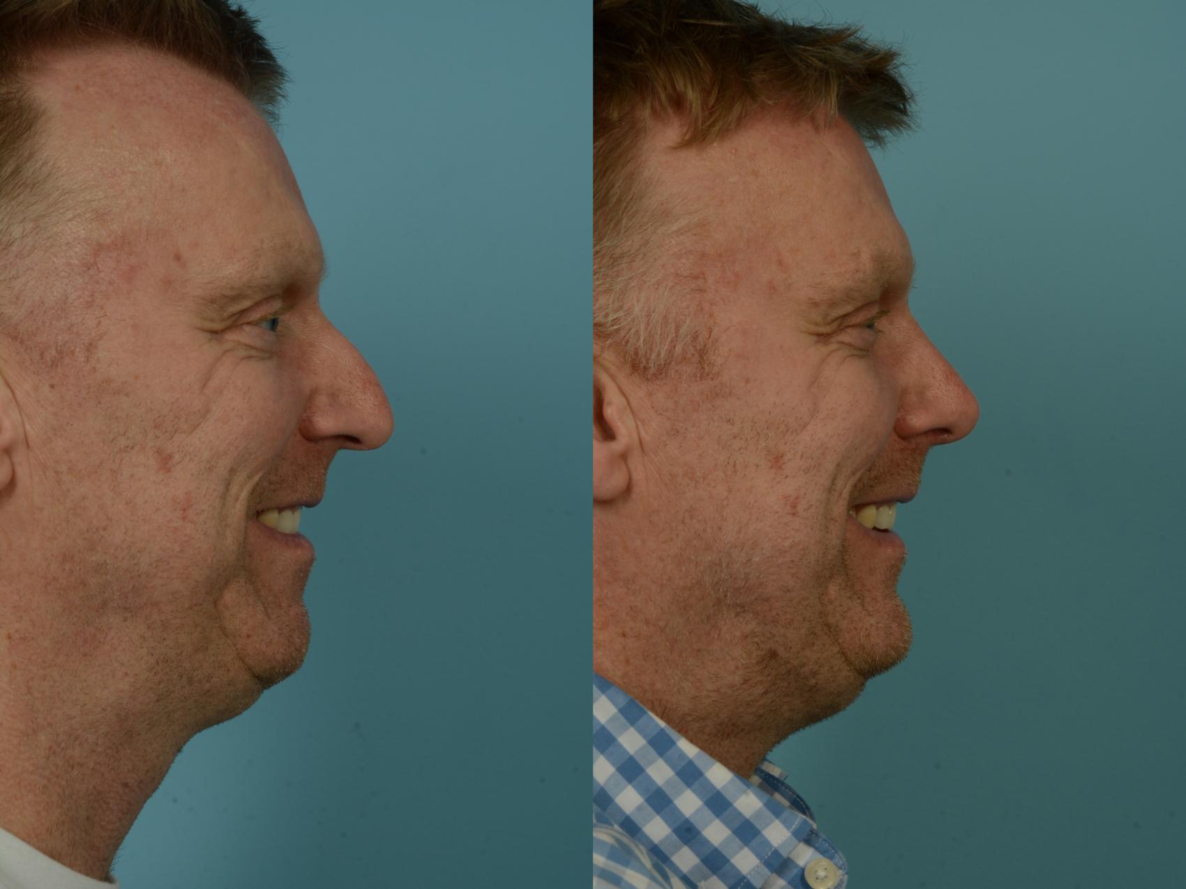 Before & After Rhinoplasty by Dr. Sinno Case 907 Right Side View in Chicago, IL