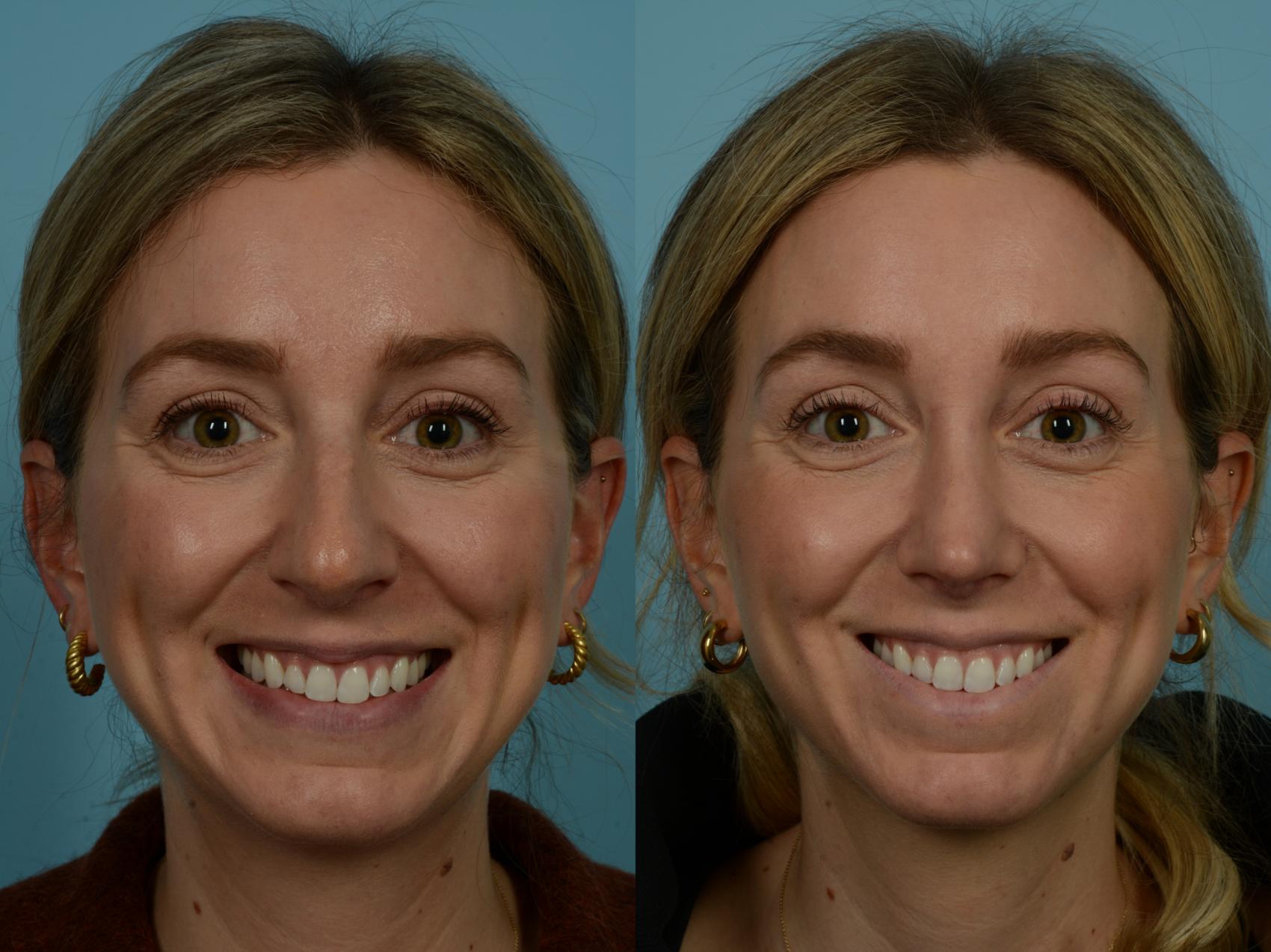 Before & After Rhinoplasty by Dr. Sinno Case 910 Front View in Chicago, IL