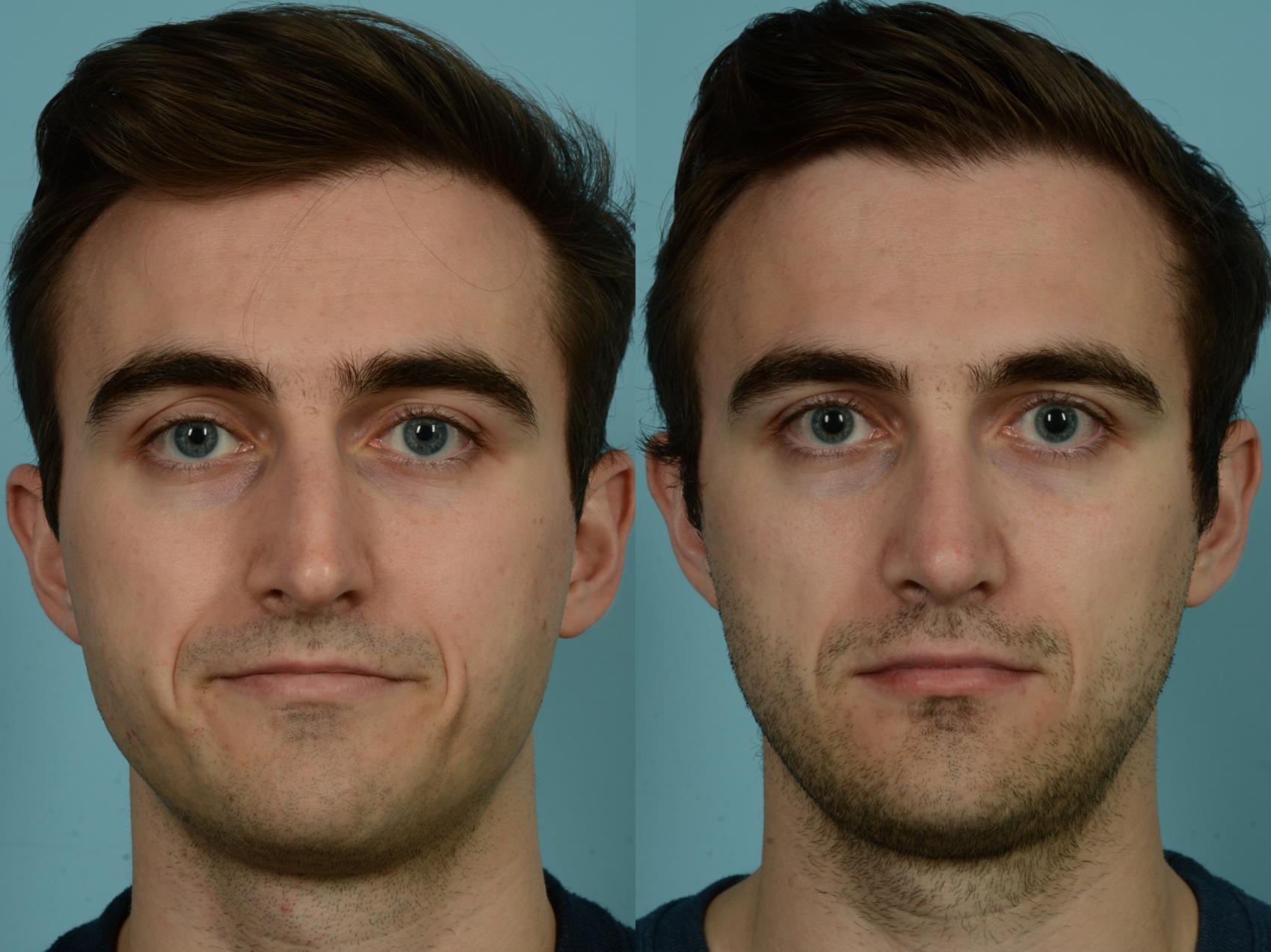 Before & After Rhinoplasty by Dr. Sinno Case 914 Front View in Chicago, IL