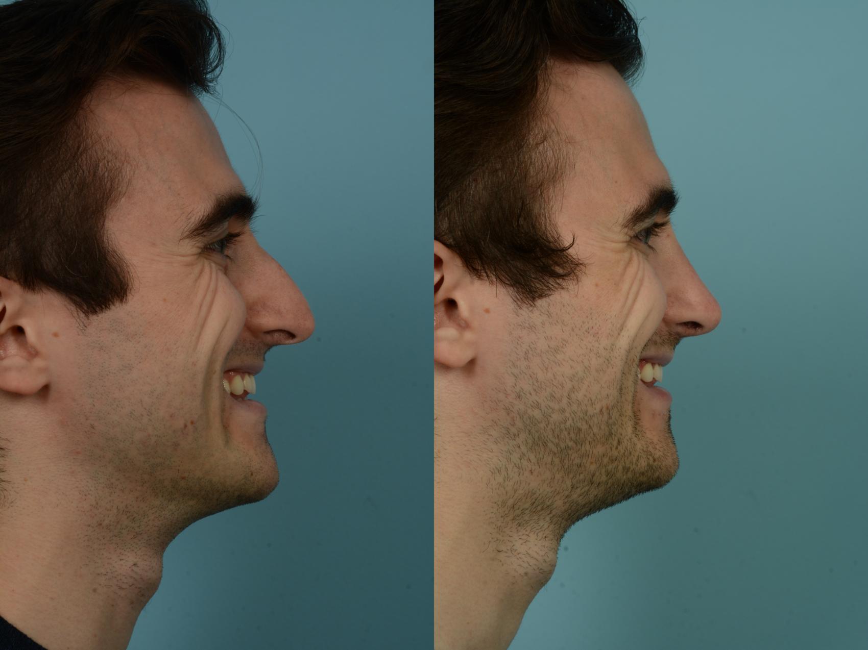 Before & After Rhinoplasty by Dr. Sinno Case 914 Right Side View in Chicago, IL