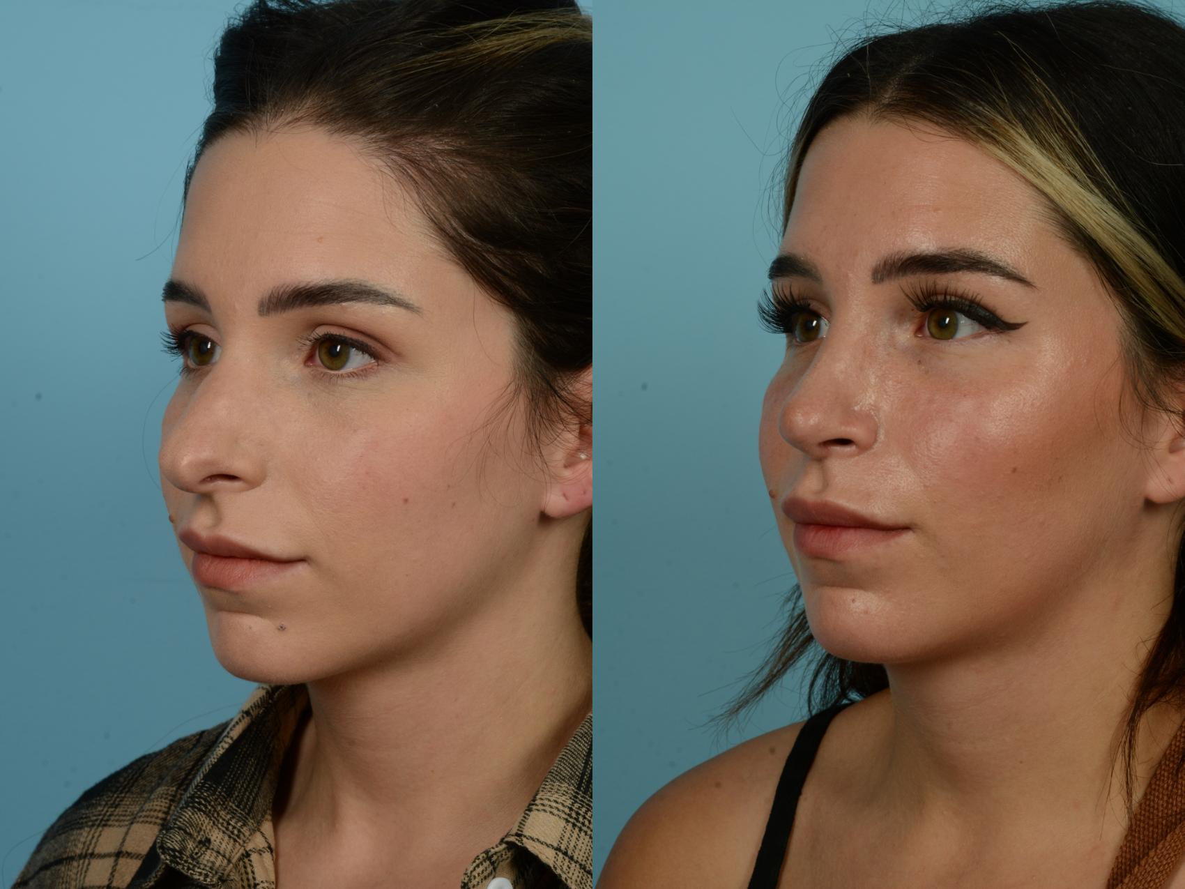 Before & After Rhinoplasty by Dr. Sinno Case 918 Left Oblique View in Chicago, IL
