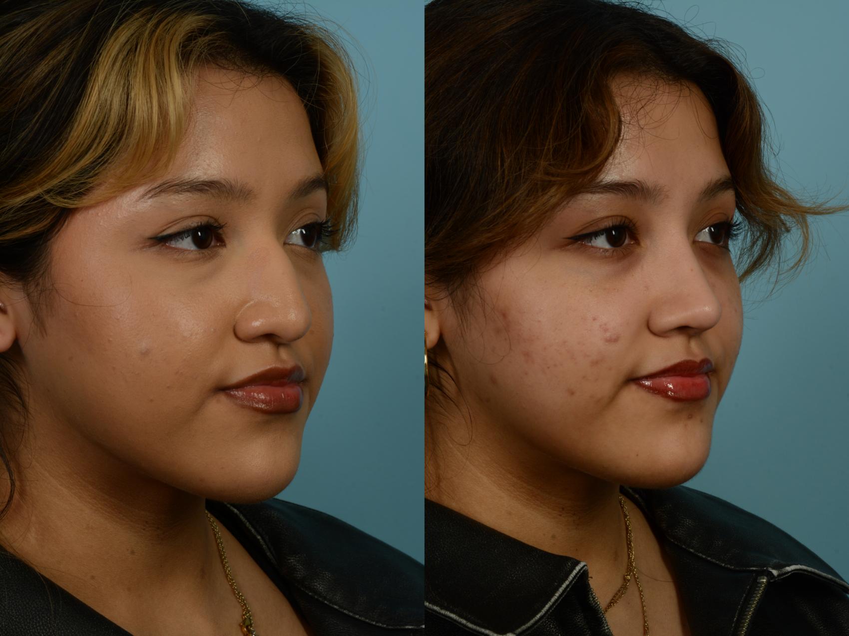 Before & After Rhinoplasty by Dr. Sinno Case 968 Right Oblique View in Chicago, IL