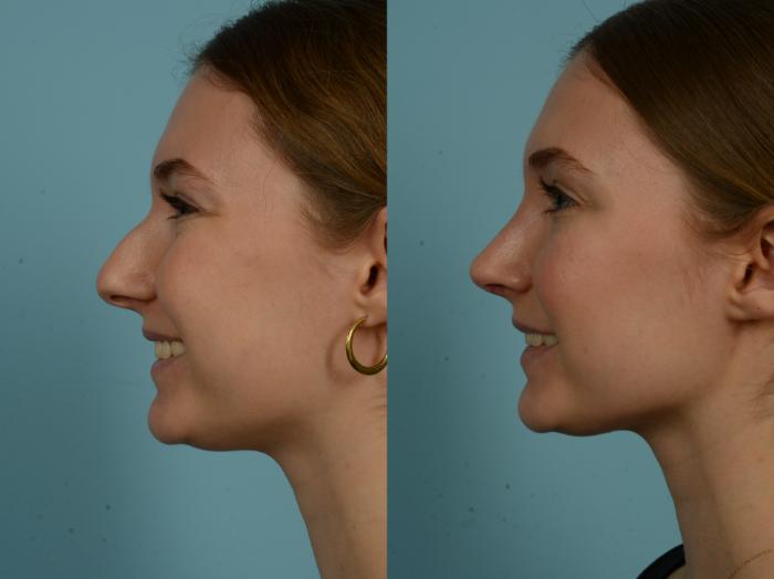 Before & After Rhinoplasty by Dr. Sinno Case 974 Left Side View in Chicago, IL
