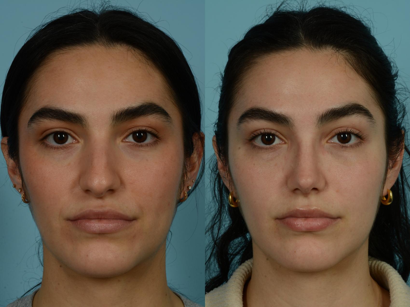 Before & After Rhinoplasty by Dr. Sinno Case 986 Front View in Chicago, IL
