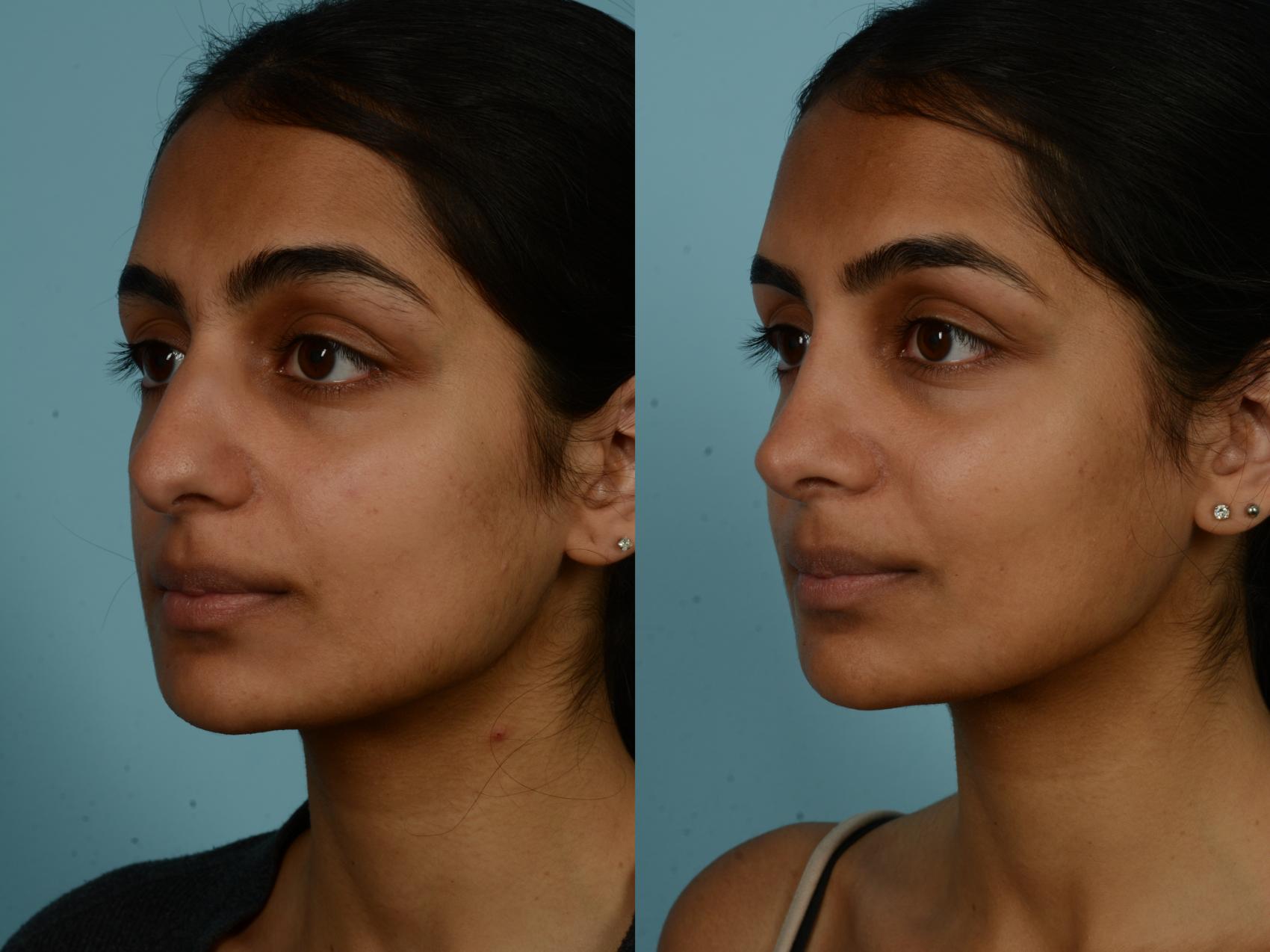 Before & After Rhinoplasty by Dr. Sinno Case 993 Left Oblique View in Chicago, IL