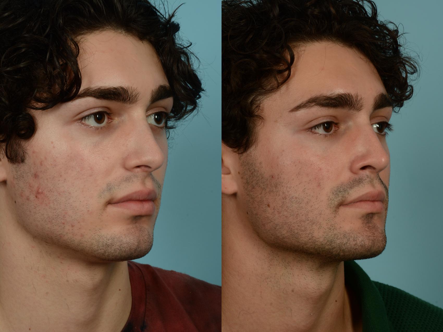 Before & After Rhinoplasty by Dr. Sinno Case 996 Right Oblique View in Chicago, IL