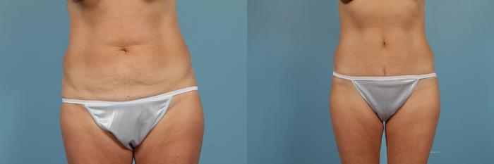 Before & After Tummy Tuck Case 203 View #1 View in Chicago, IL