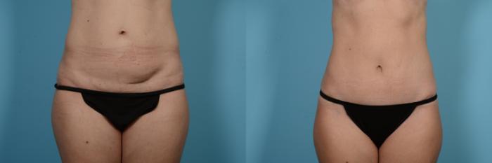 Before & After Tummy Tuck Case 550 Front View in Chicago, IL